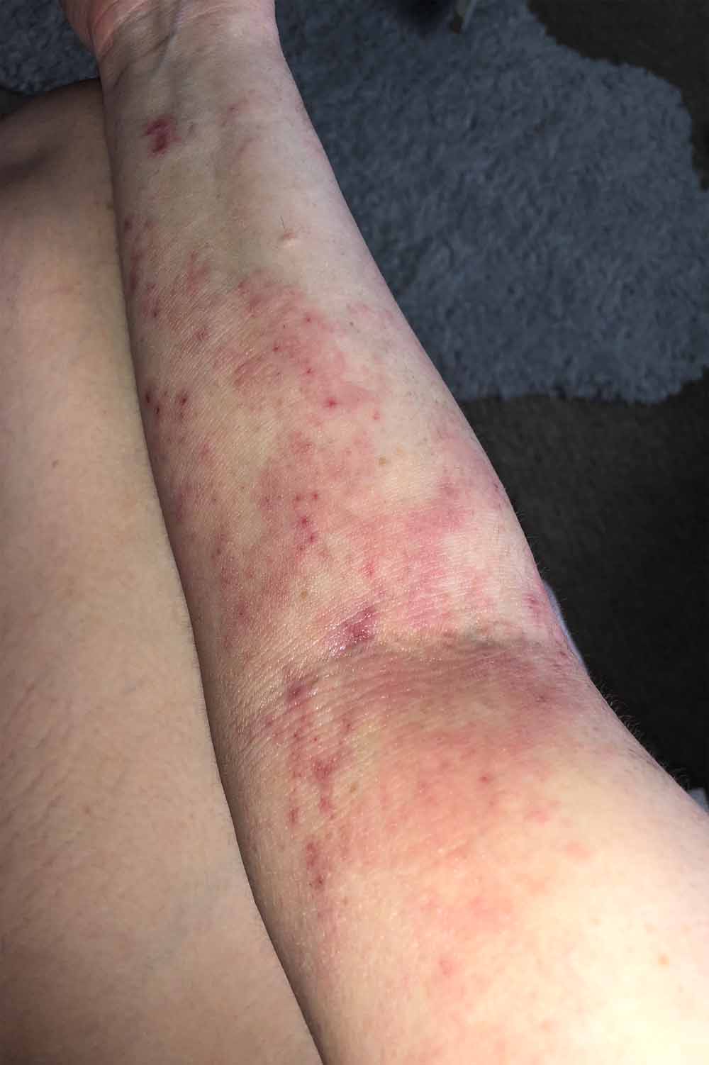 eczema cream