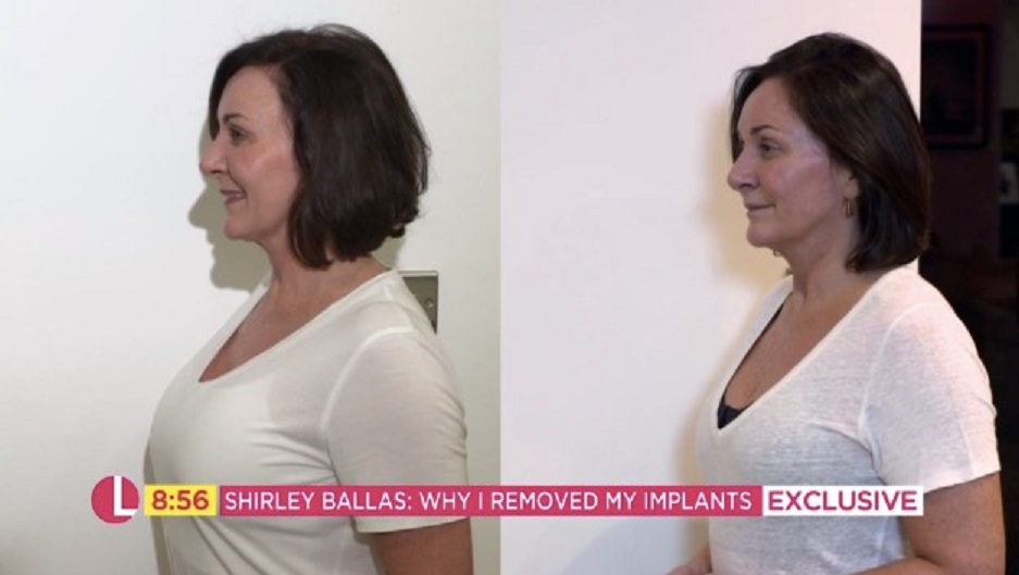 Shirley Ballas before and after the surgery 