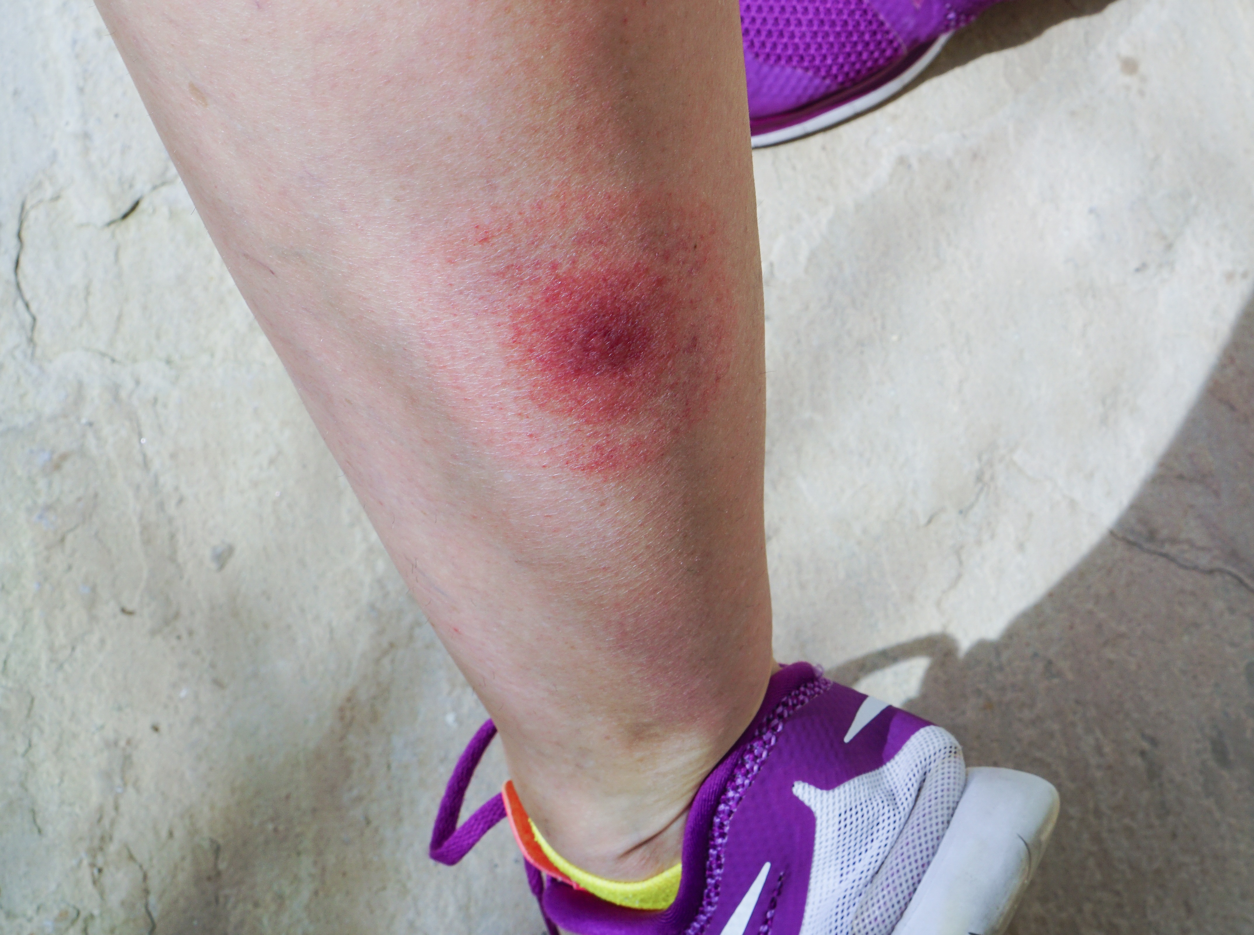 Typical Lyme disease bullseye rash on leg (istock/PA)