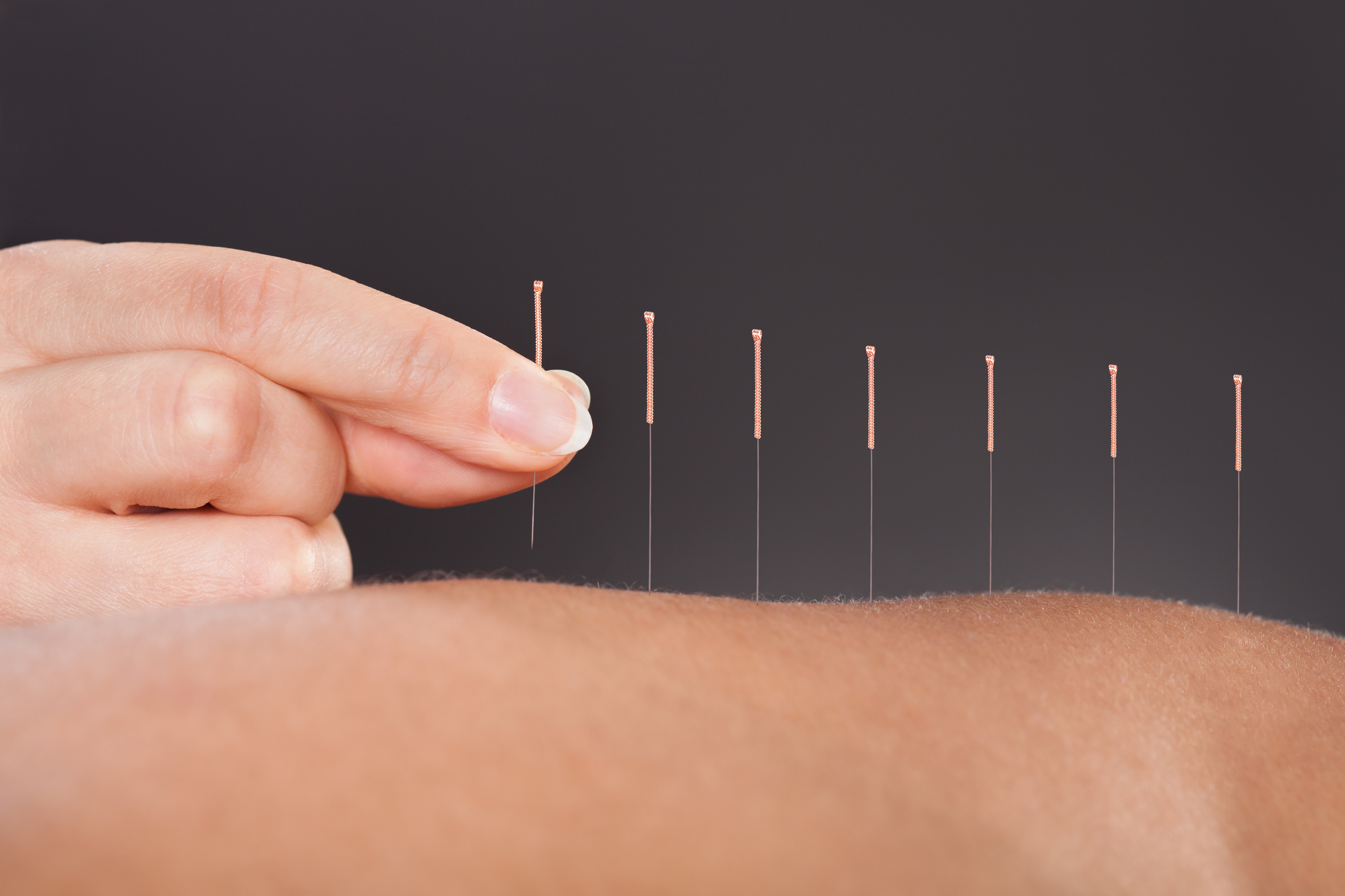 Acupuncture Treatment