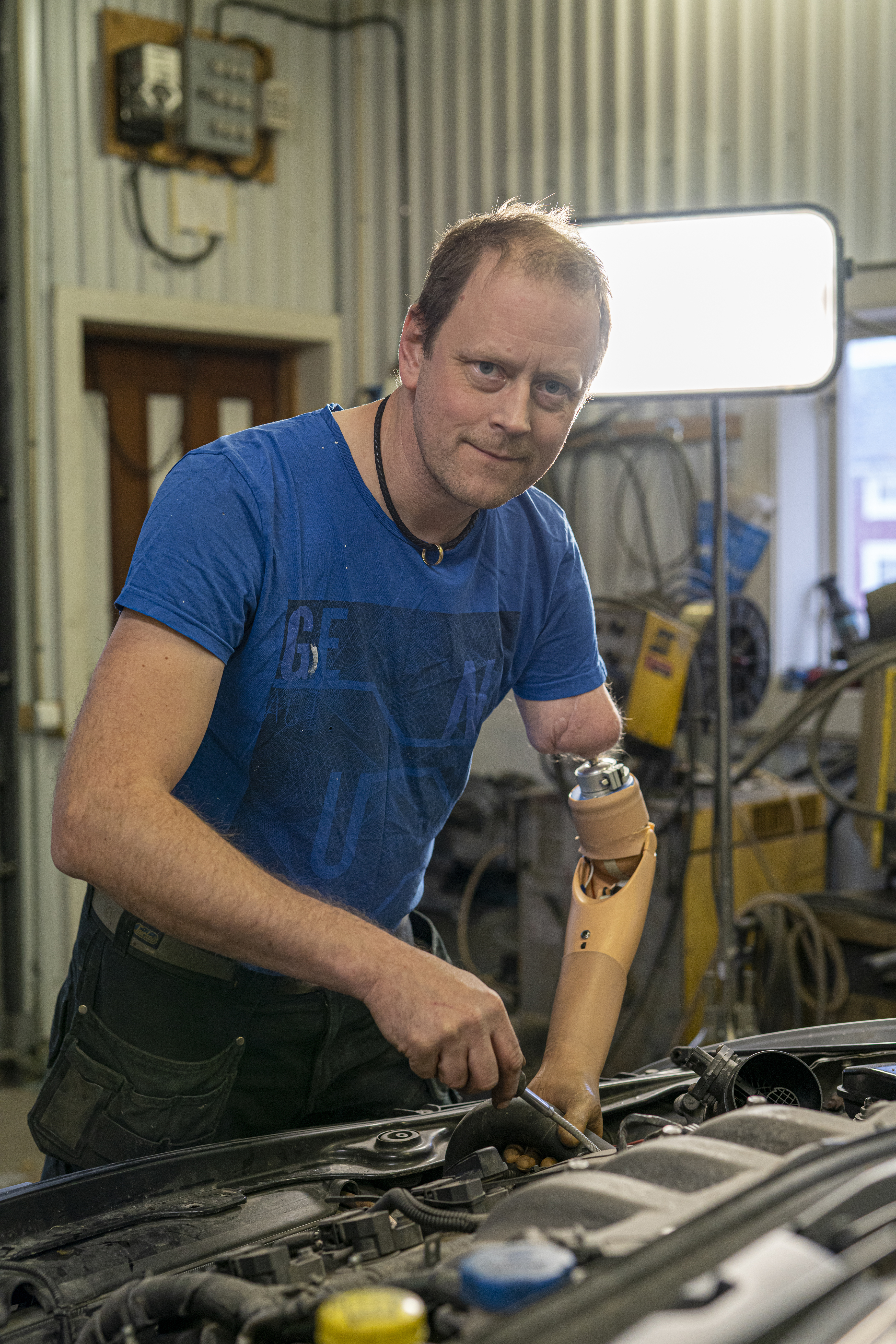 One of the patients in the study has had his mind-controlled arm prosthesis since the beginning of 2017