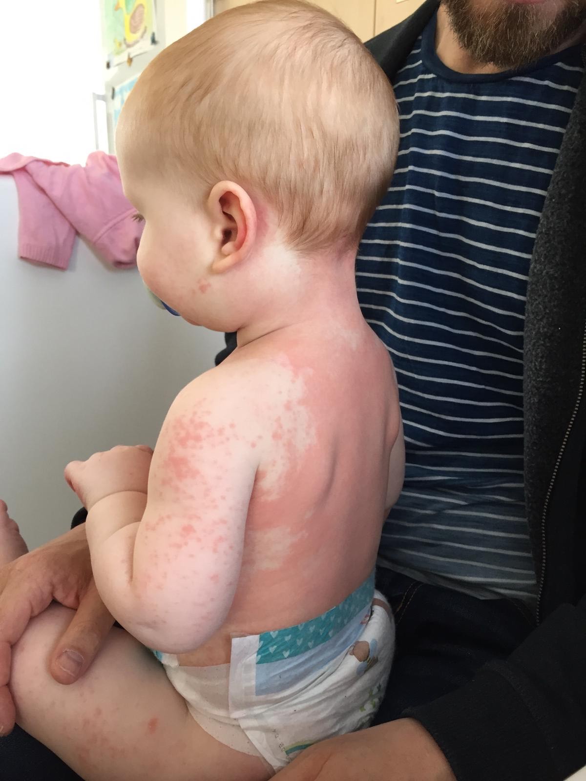 Alexander developed a rash across his back, which spread to the rest of his body (Family handout/PA Wire)