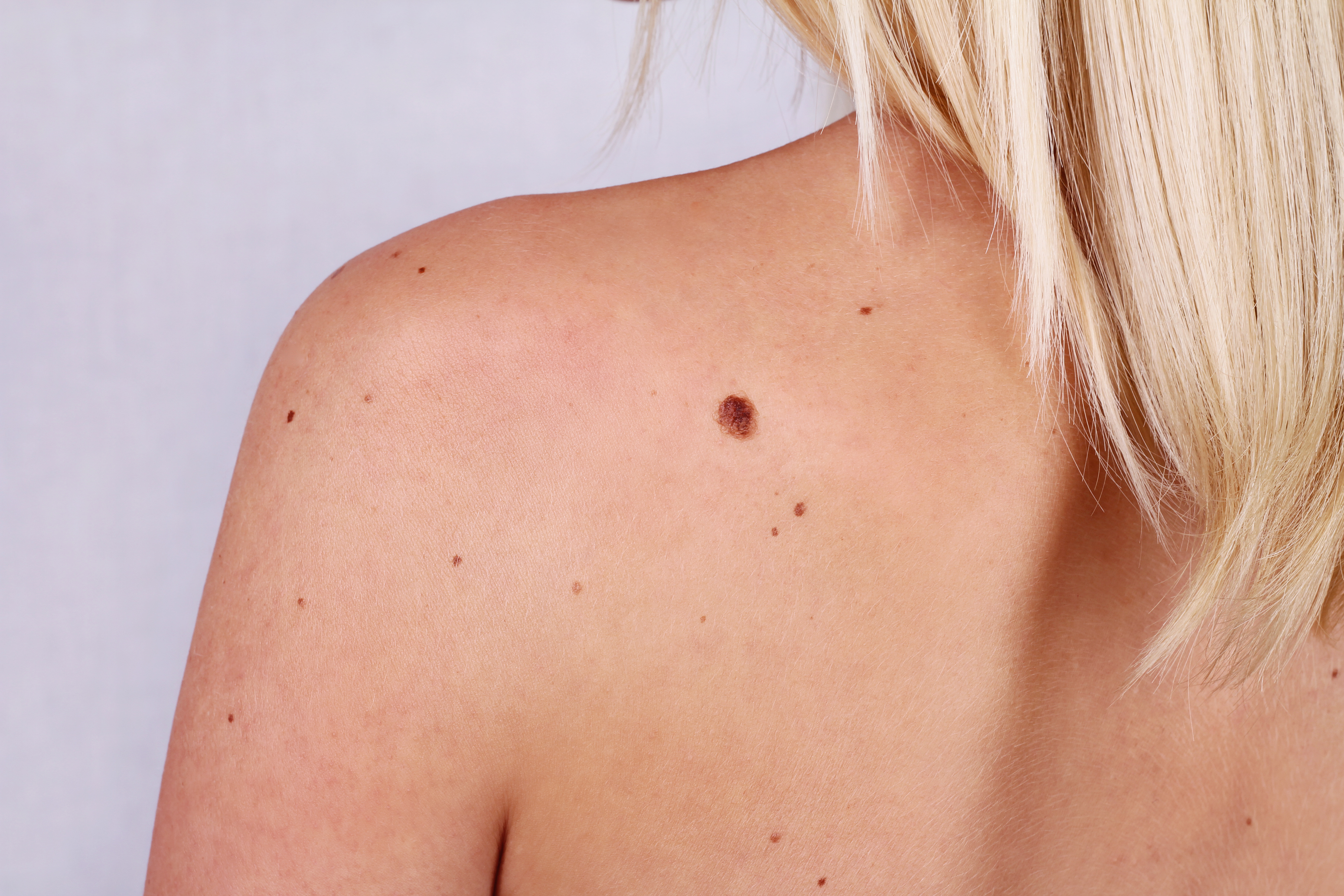 How To Know If Your Mole Needs To Be Looked At By A Doctor Sustain