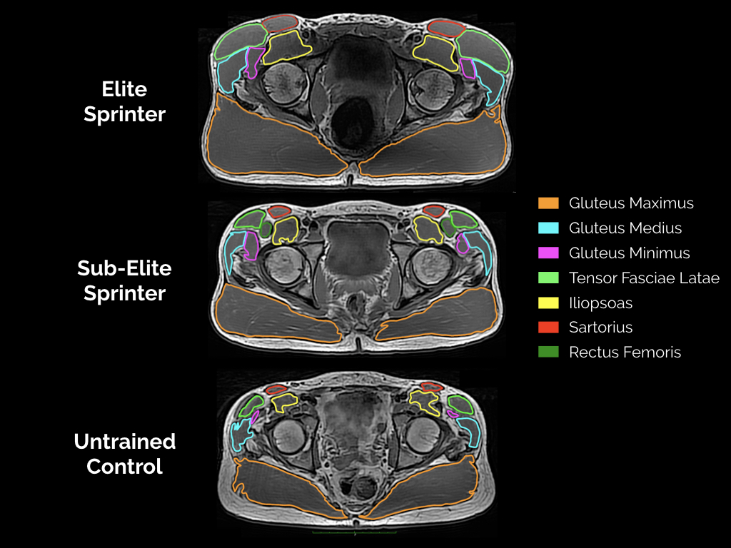 Hip Muscle MRI example of 3 different individuals