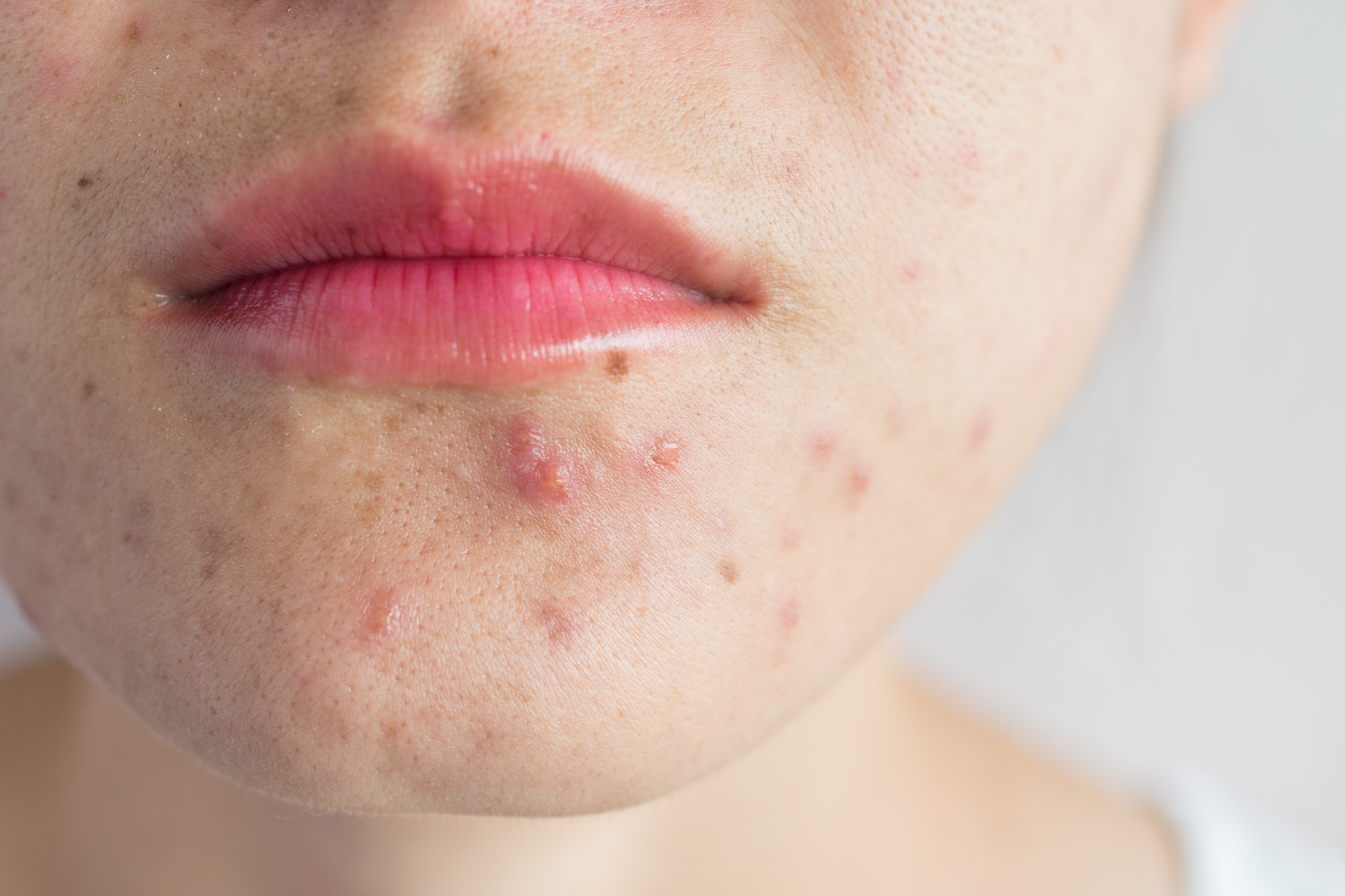 Close-up of woman half face with problems of acne inflammation (Papule and Pustule) on her face.