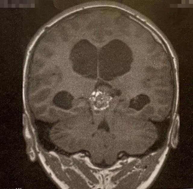 Optician Saved Life Of 13-Year-Old From Eastbourne After Spotting Signs