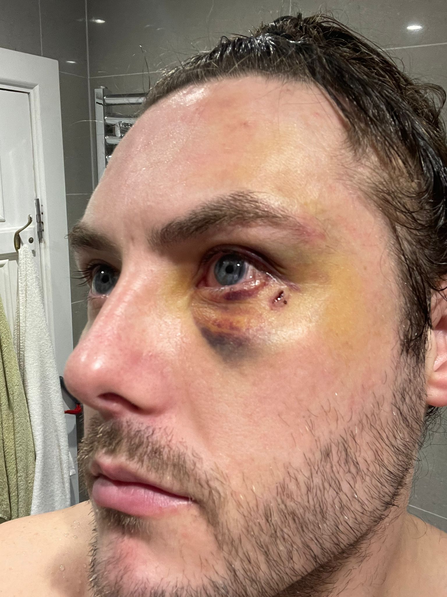 Cuts and bruises on Alan Hunter's face