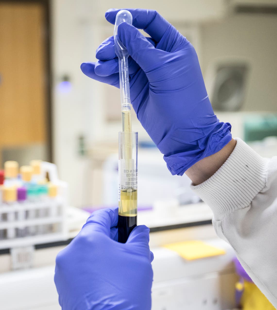 Blood test could detect recurrent melanoma up to a year before scans