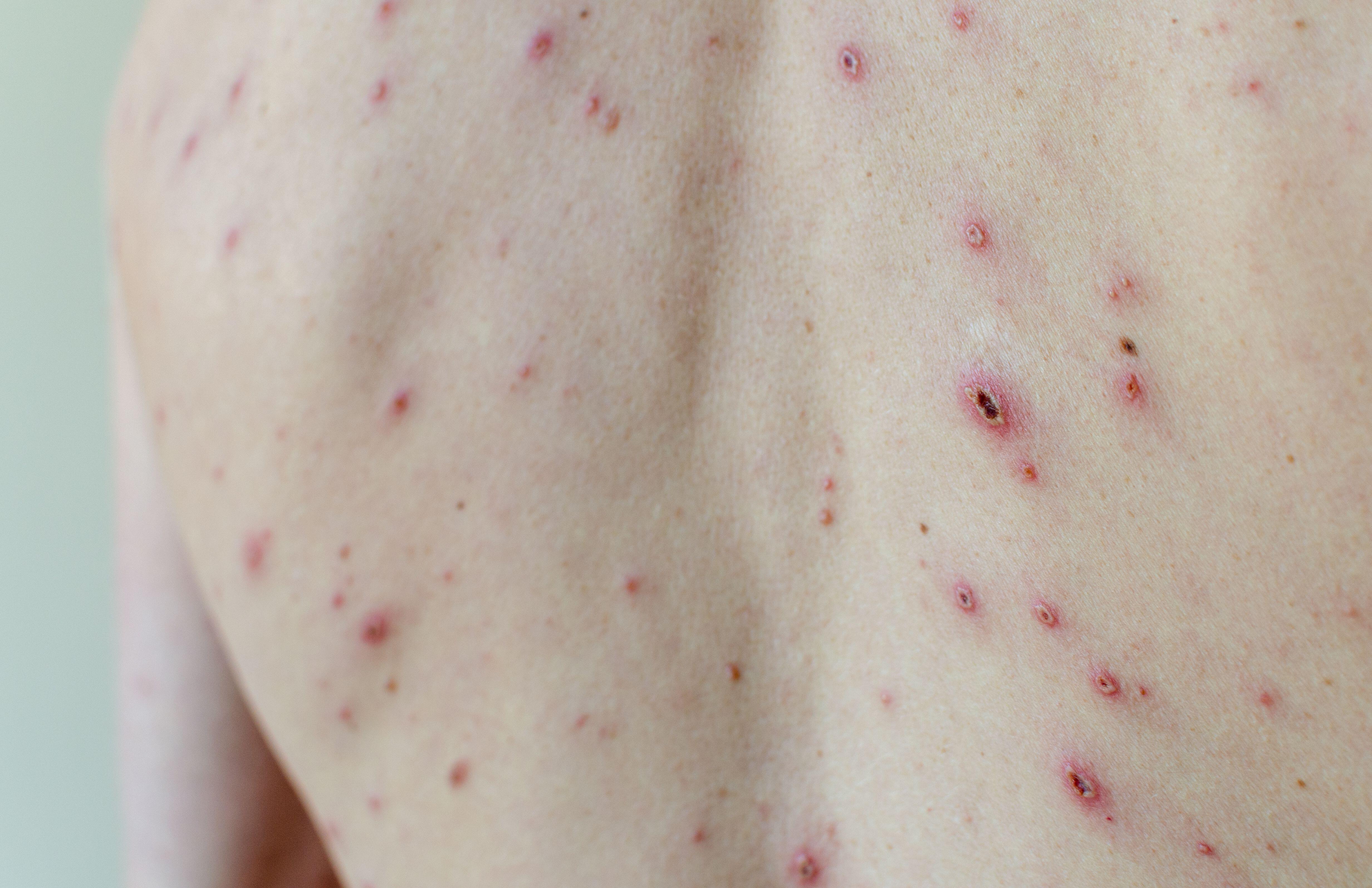 Chickenpox on an adult's back