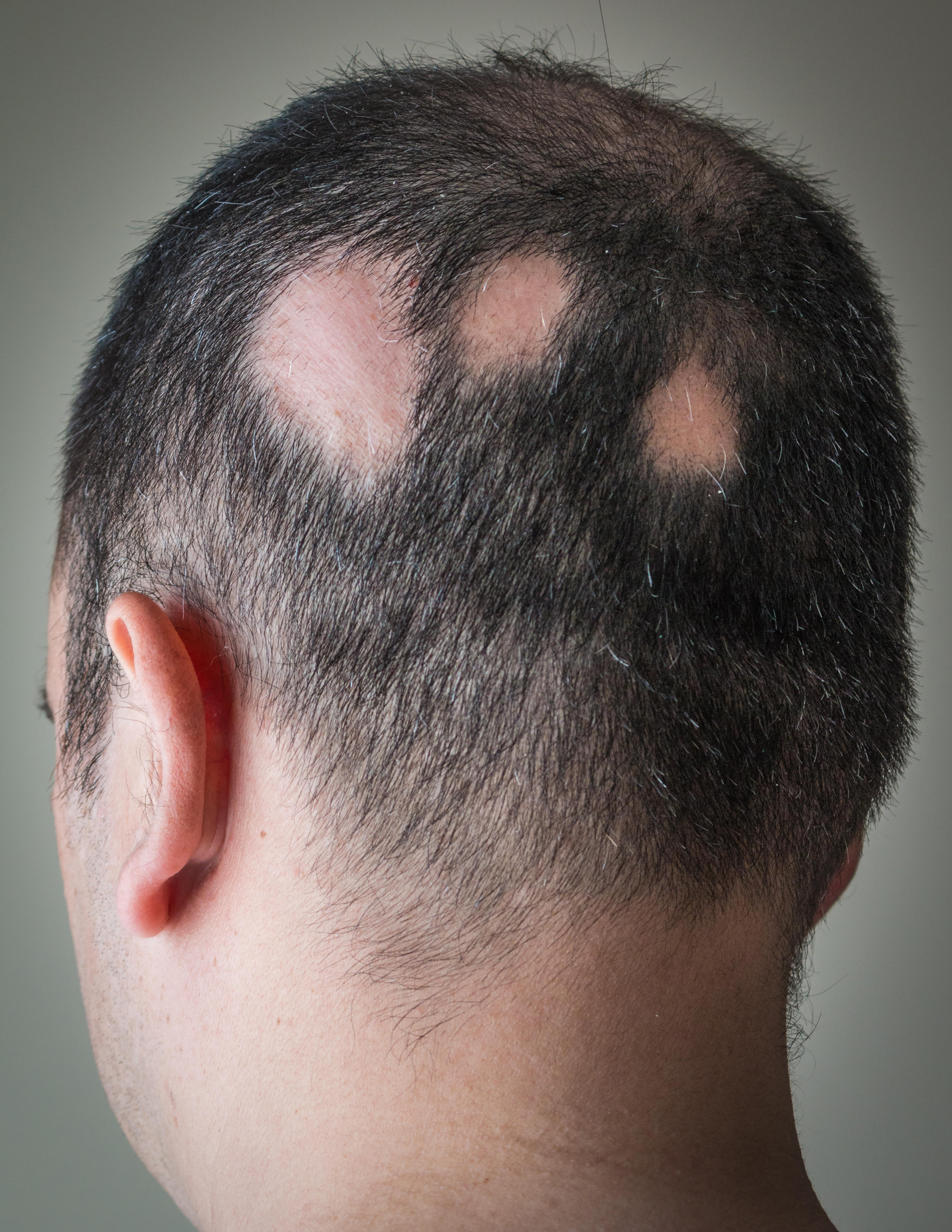 Scalp with alopecia aerata spot baldness