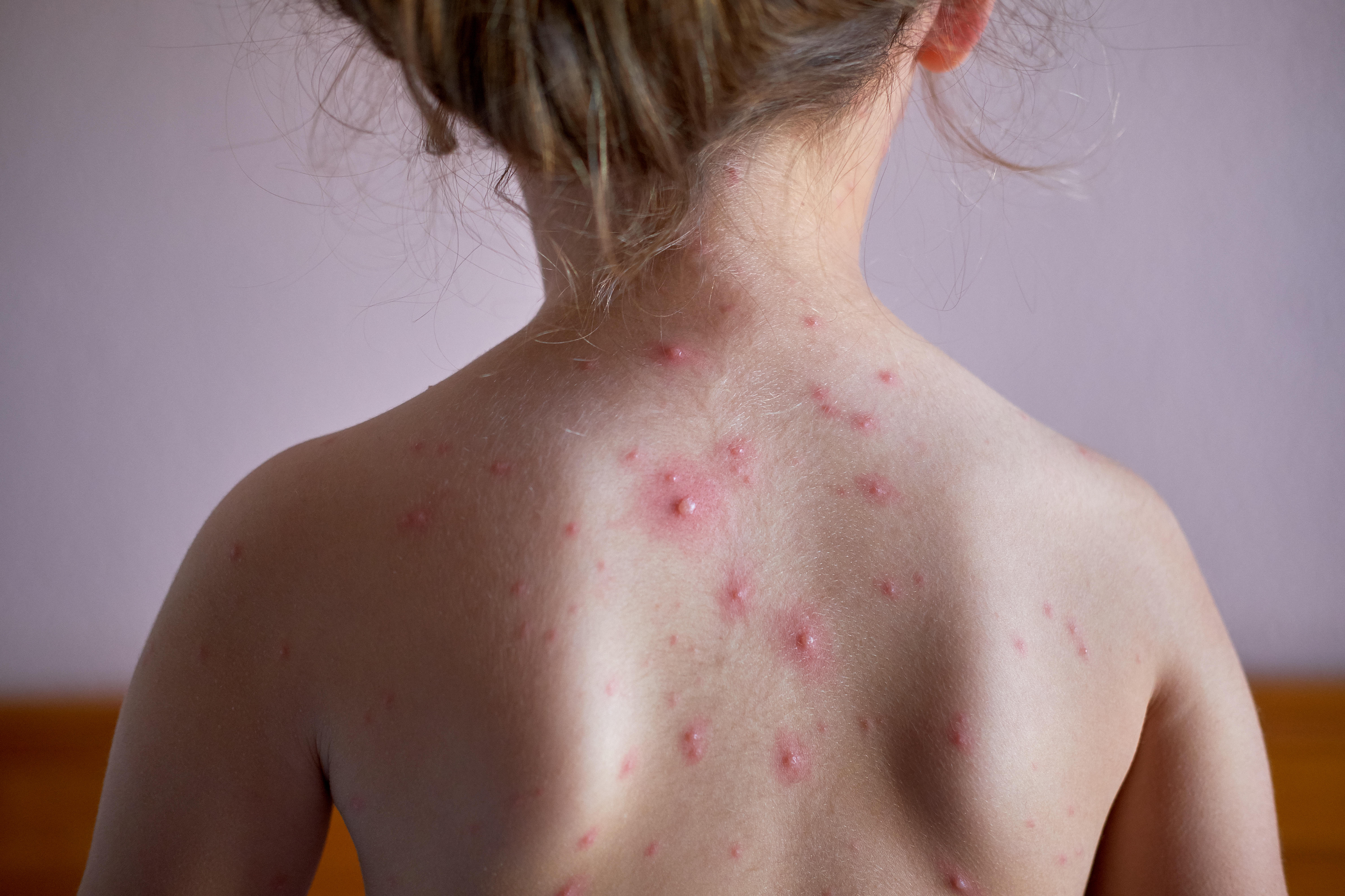 Chickenpox on child