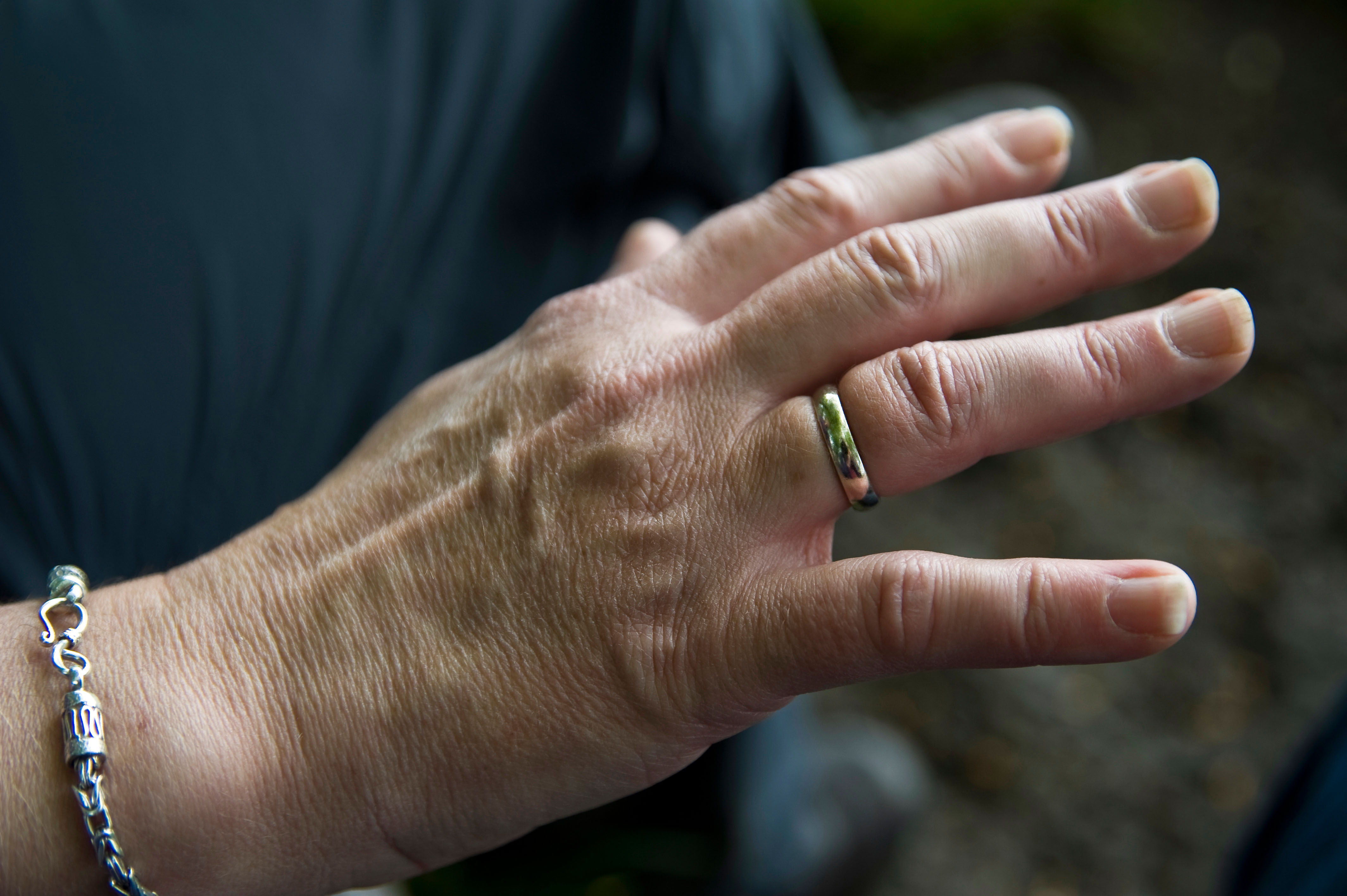 Swollen fingers with a ring on