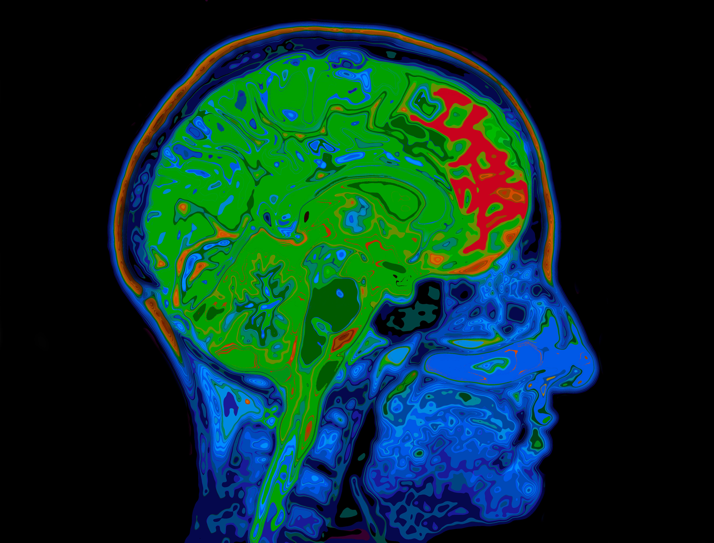 MRI scan image