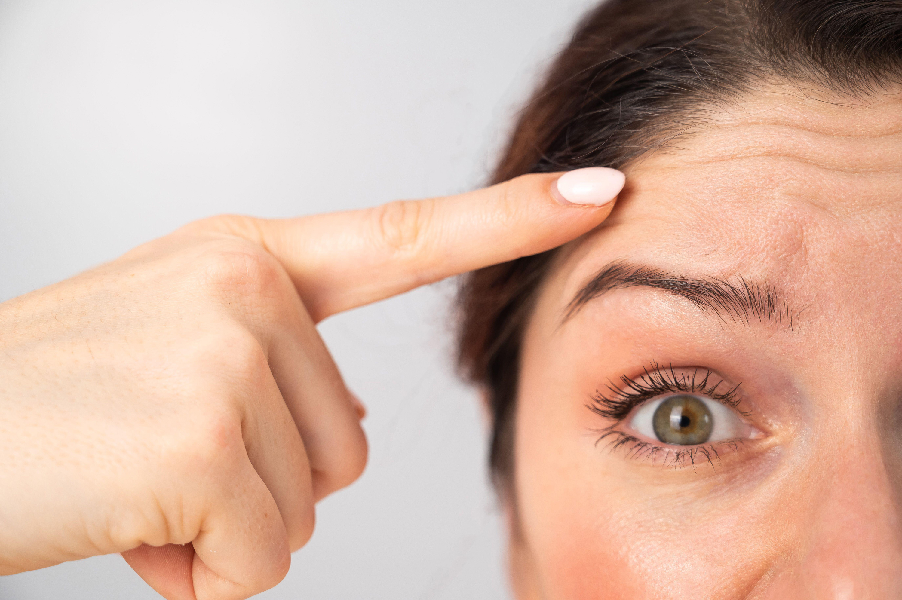 woman pointing to wrinkles on forehead