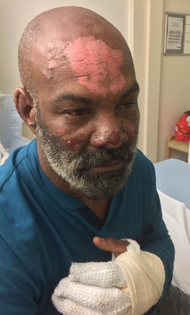 Joel Richards suffered burns on his face, head, and hand during the Rowe Court fire (Thames Valley Police/PA). 