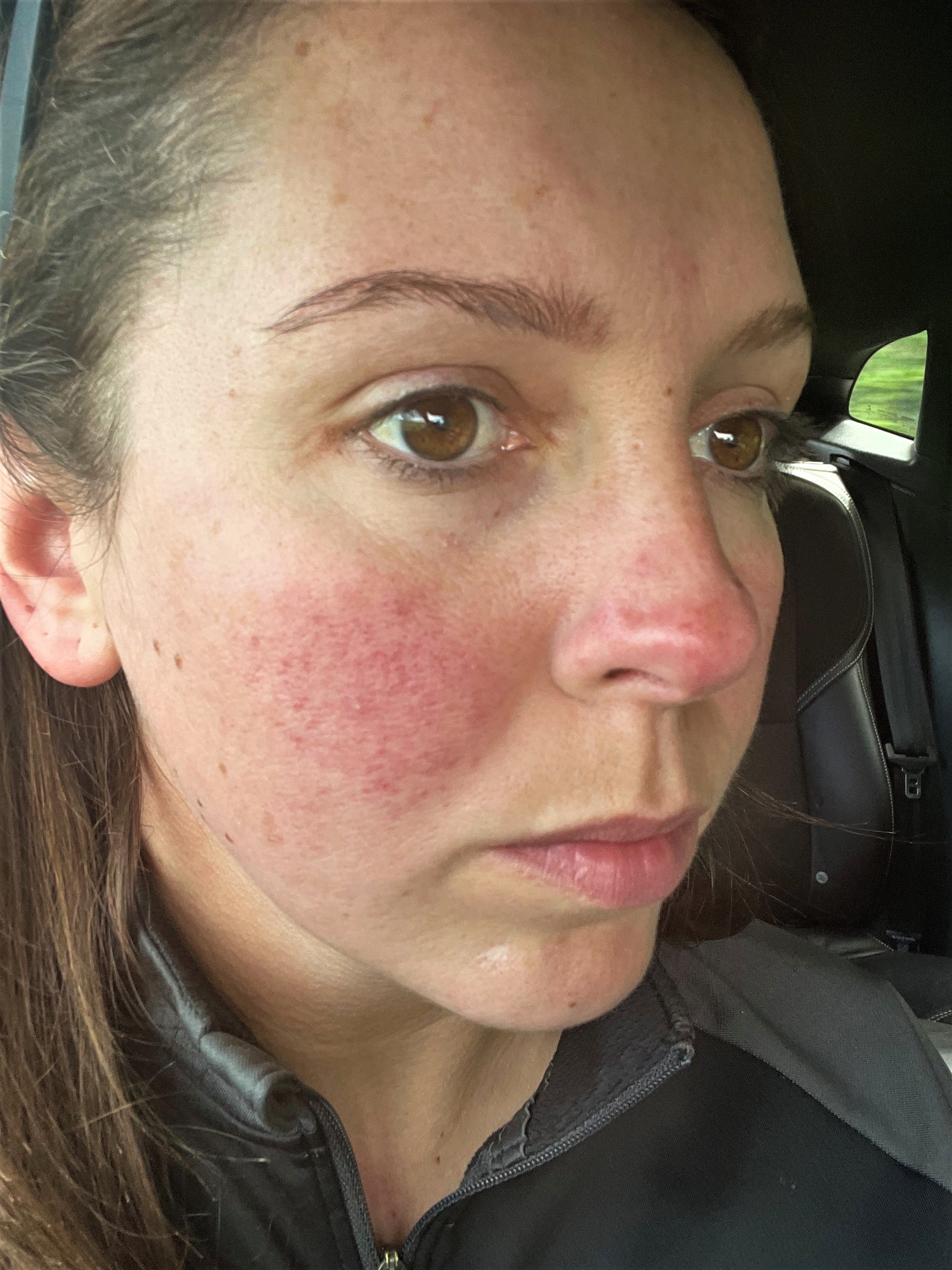 Red face during pregnancy made mum cry, until she found the cure