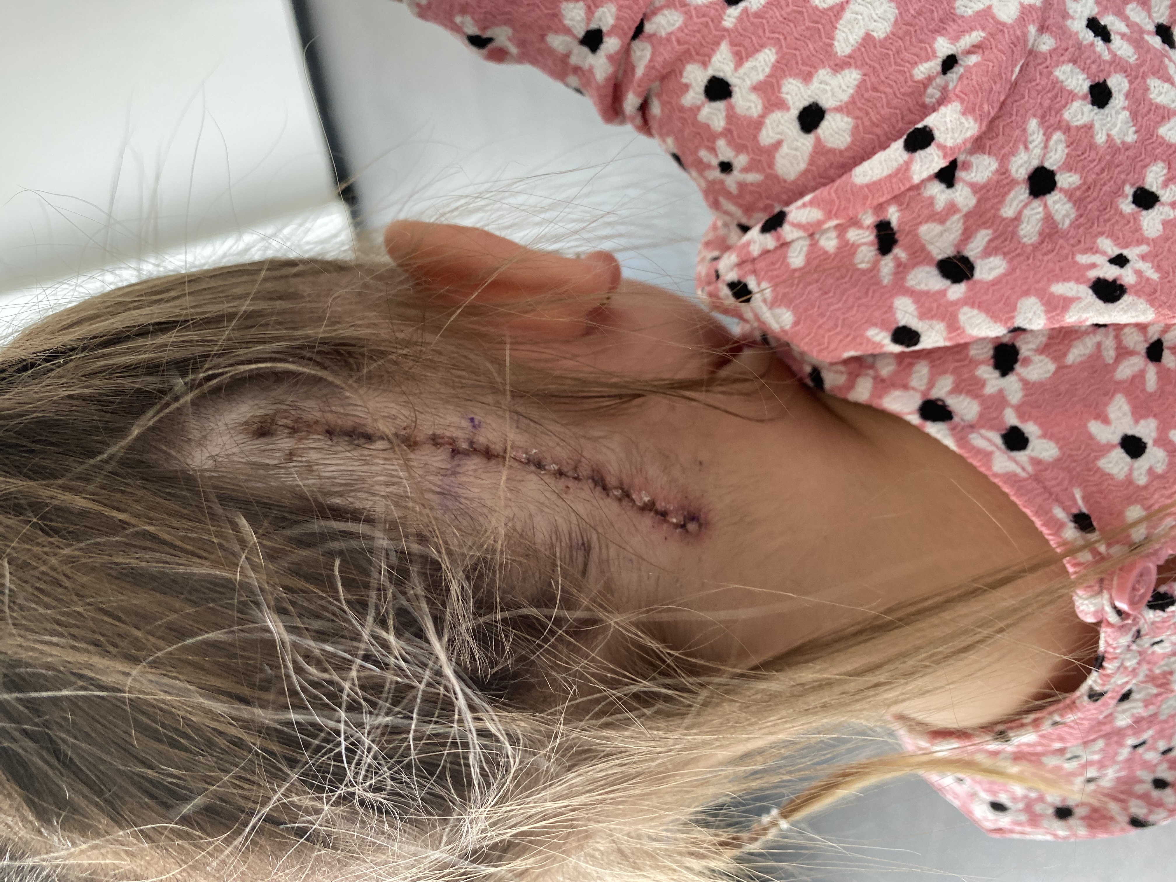 Sofia now has a five-inch scar at the back of her head (Collect/PA Real Life)