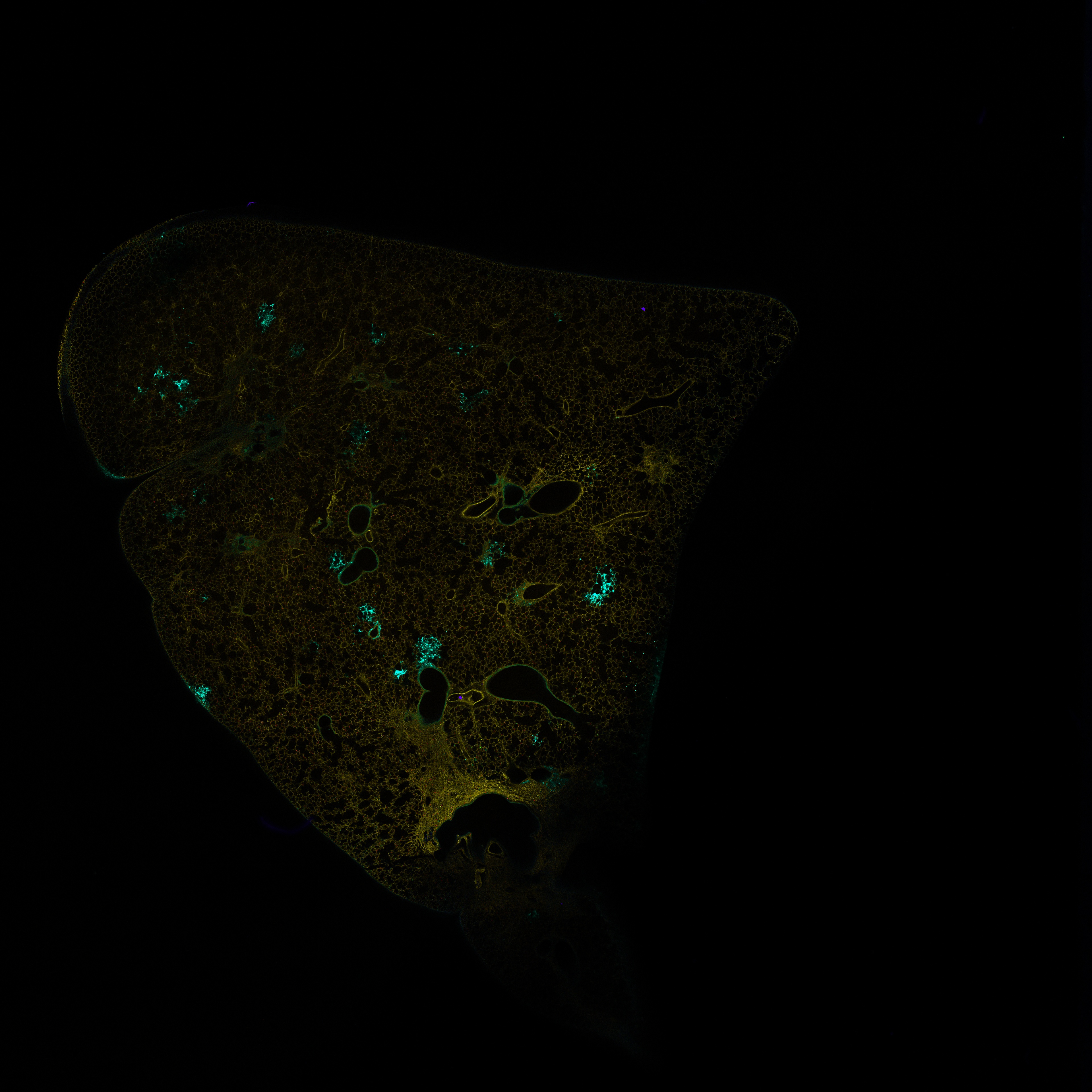 Cancer in lung