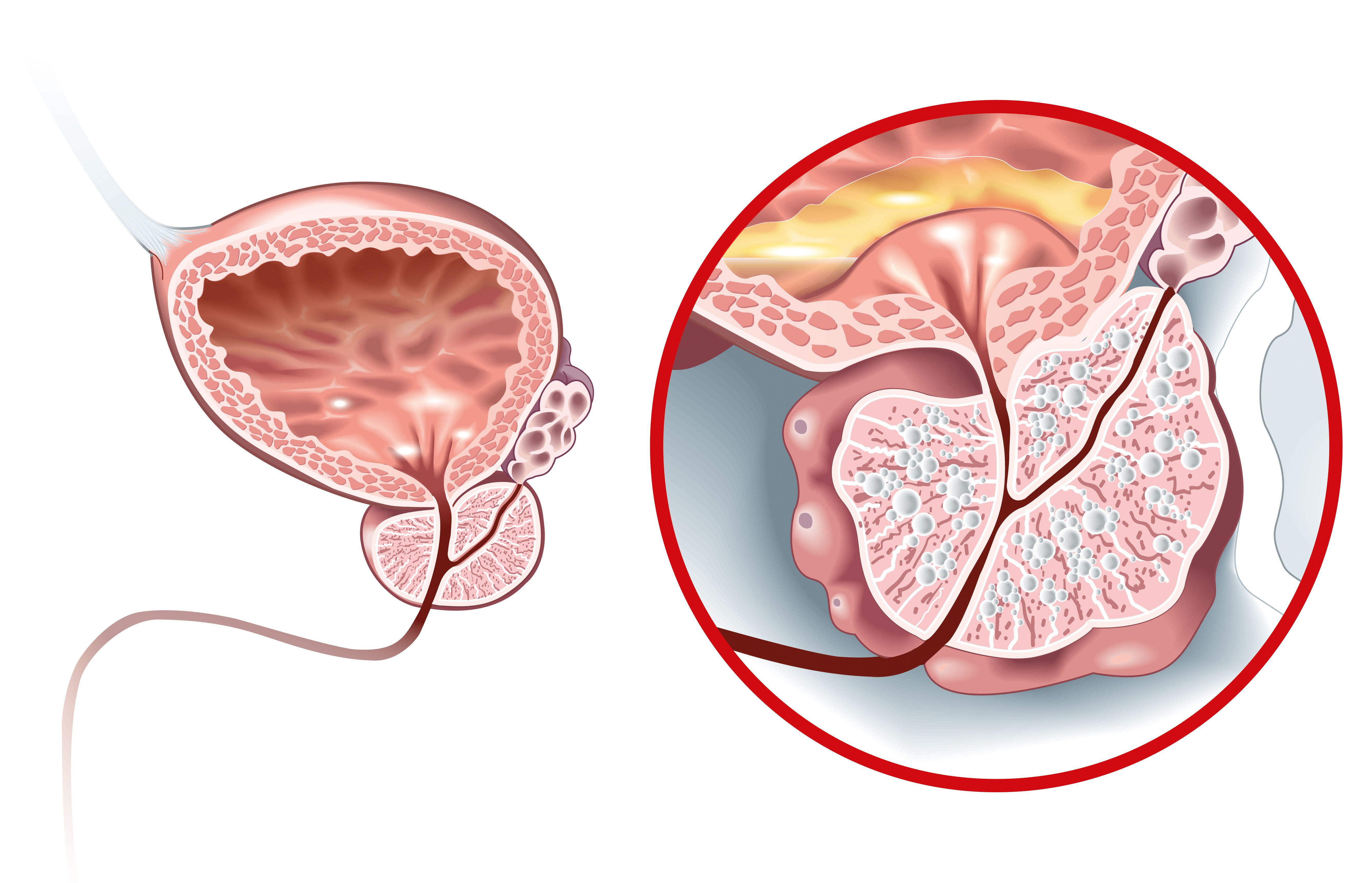 Illustration showing a healthy prostate, left, and benign prostate enlargement