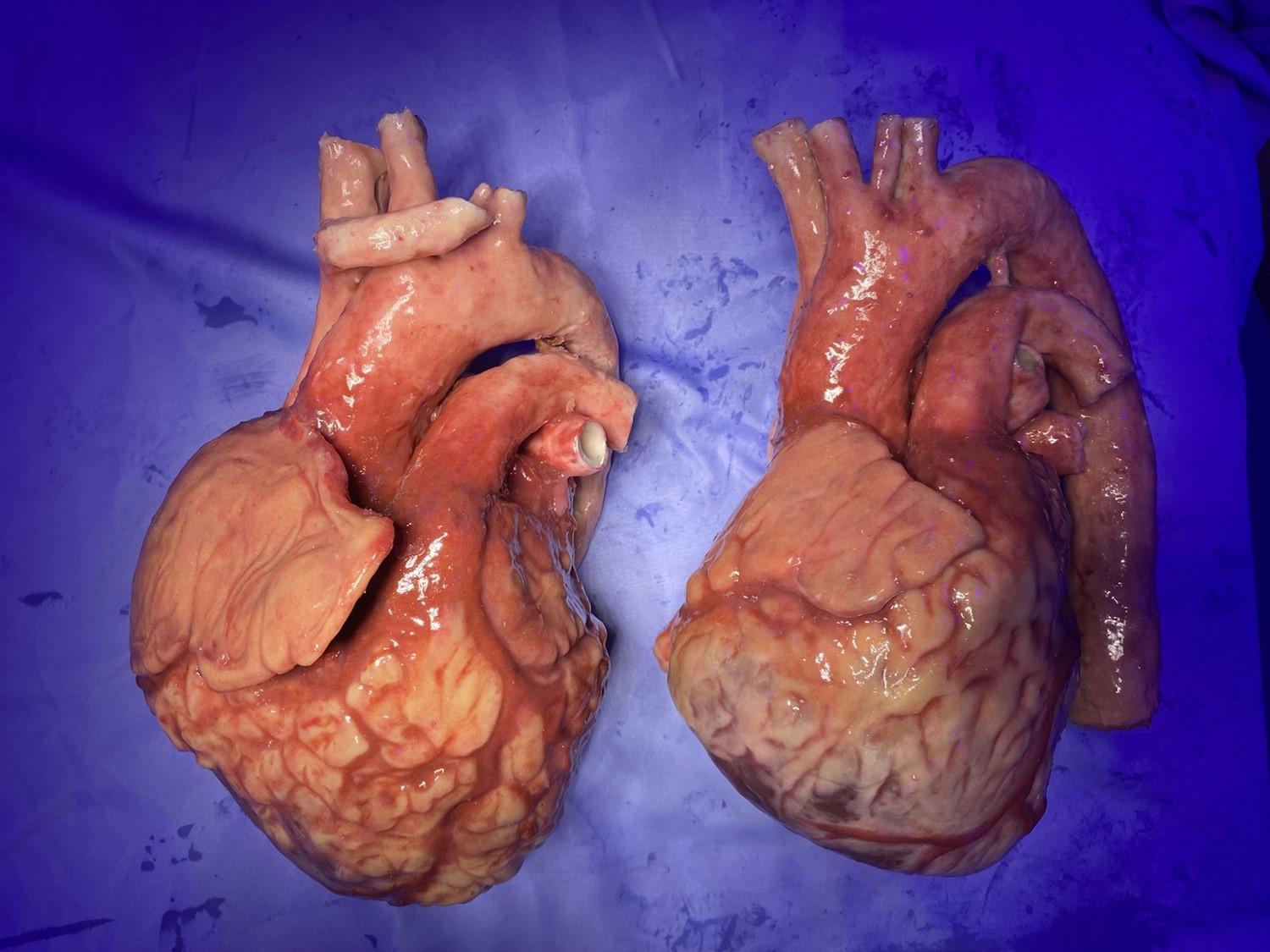 A model diseased heart, left, and a model healthy one