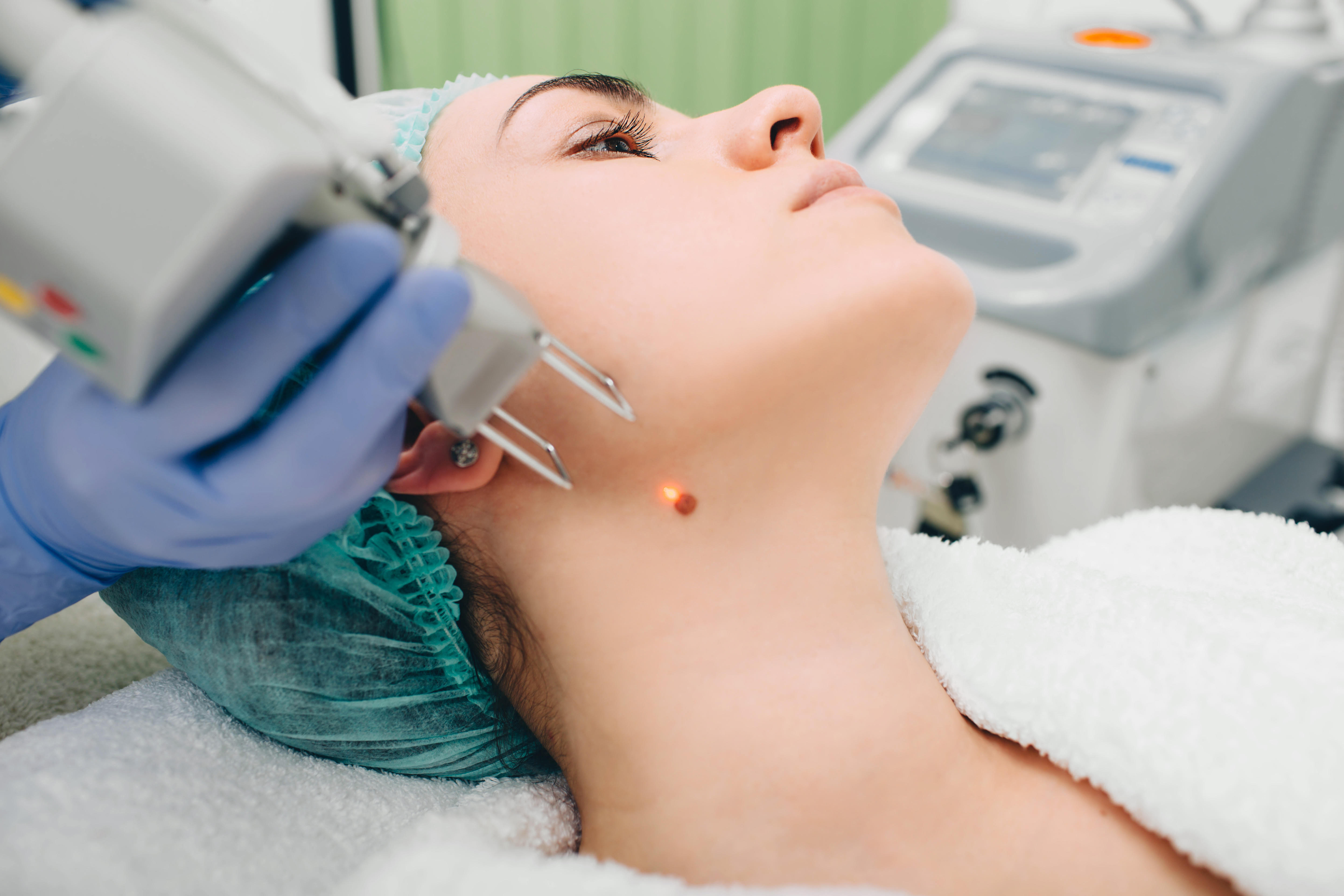 Patient getting laser mole removal.