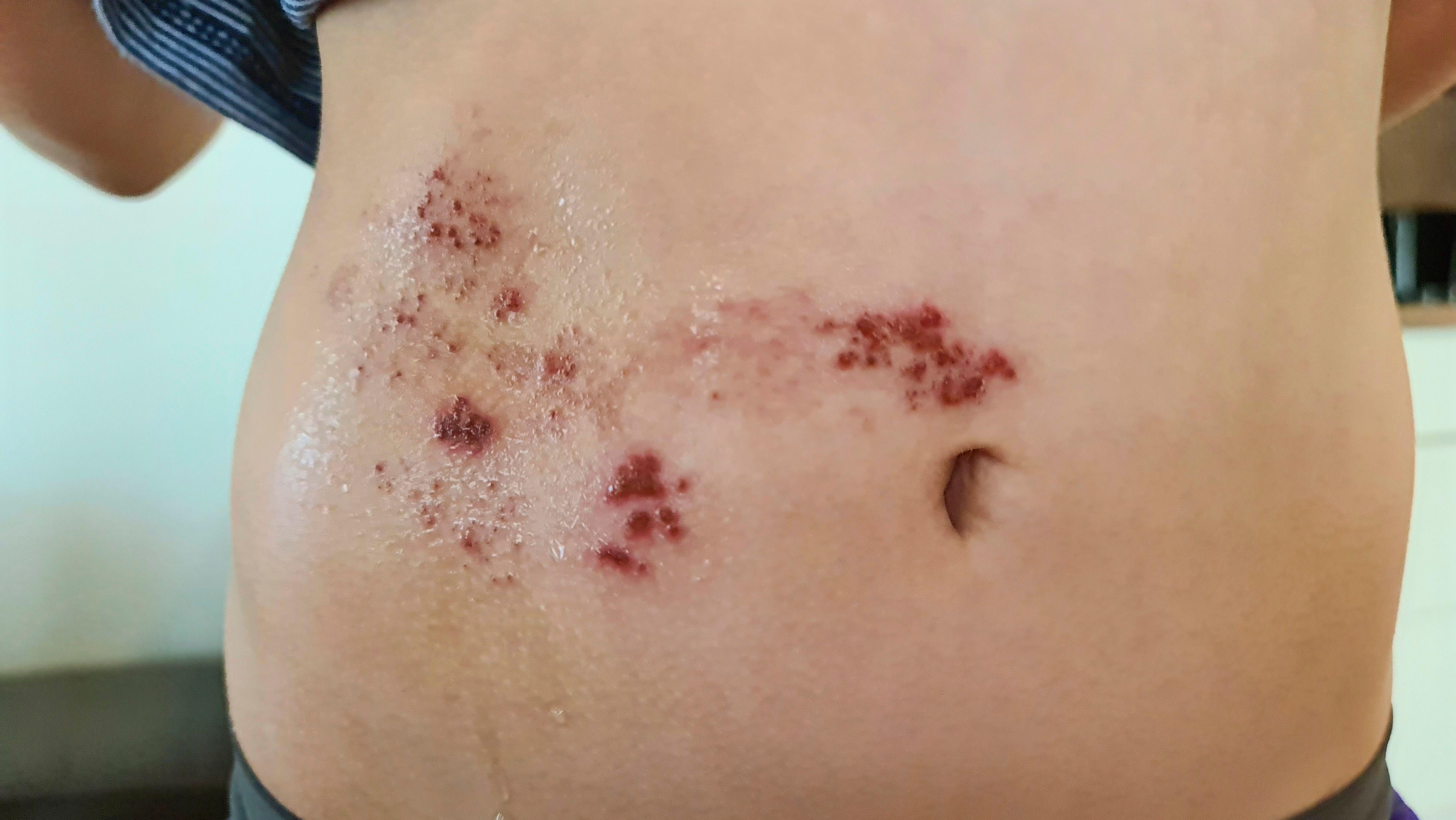 shingles rash on the belly