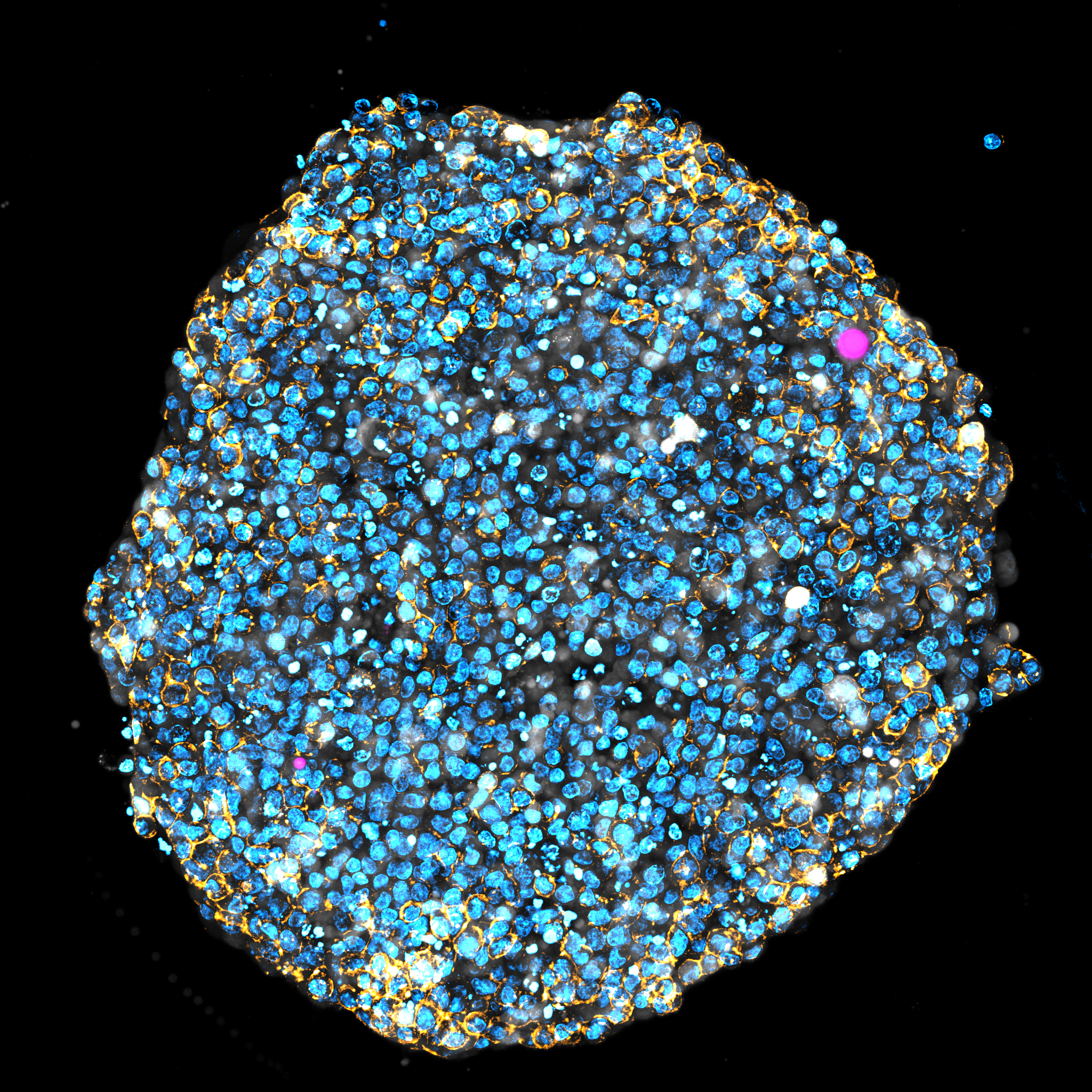 One mm wide tumour spheroid, squishy laser shown in pink