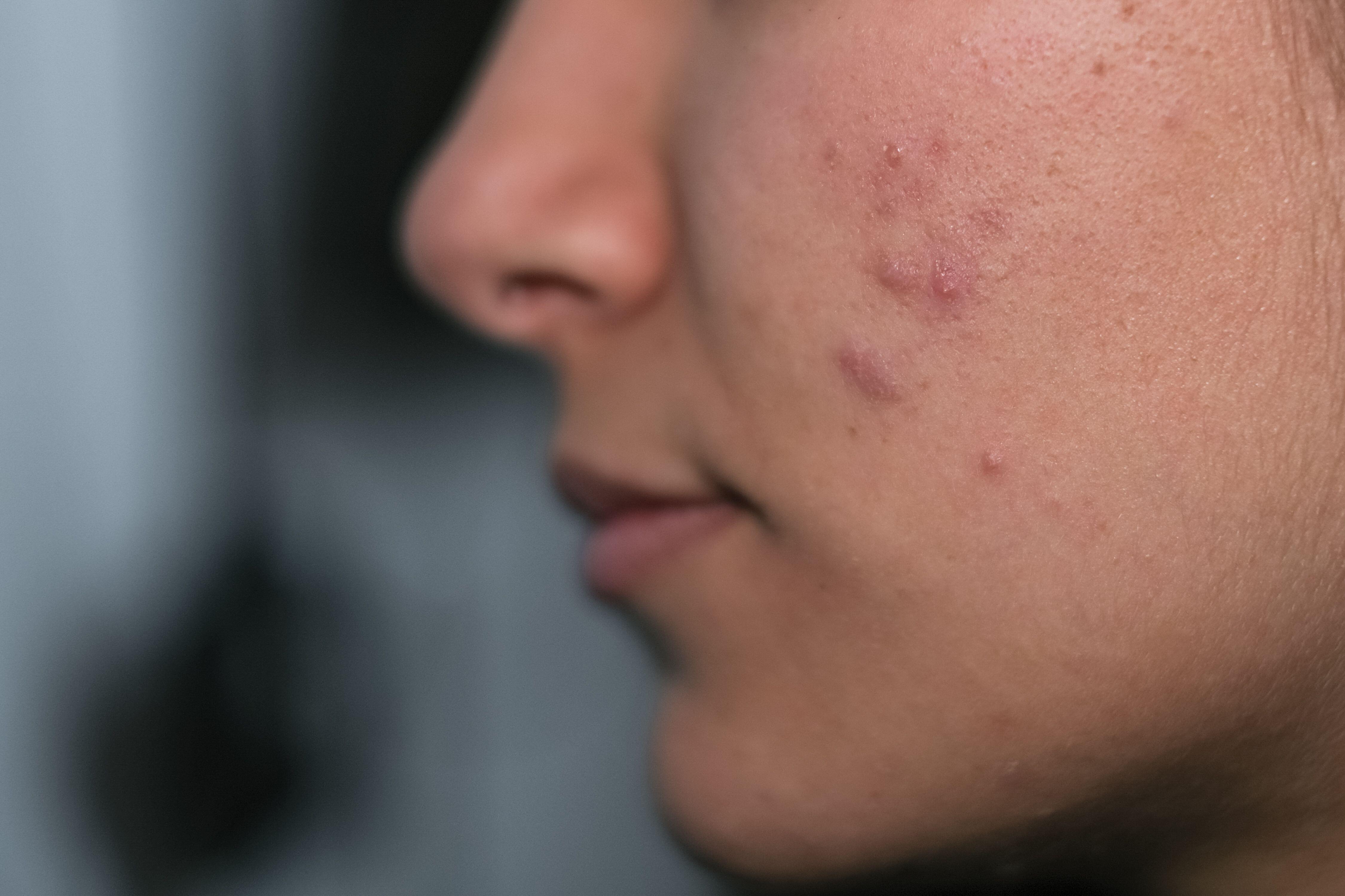 Close up of acne on young woman's face