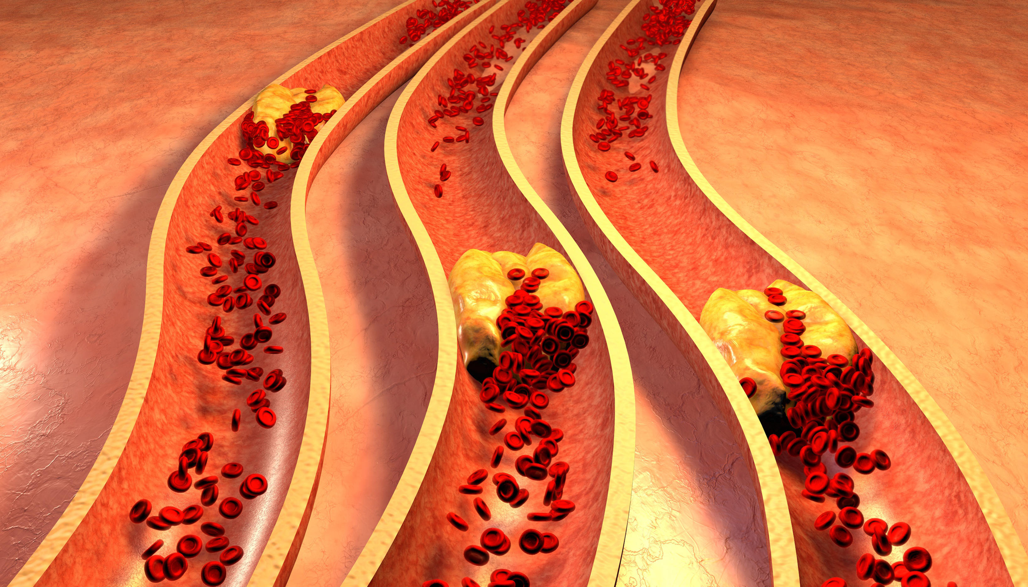 Diagram of a clogged artery with platelets and cholesterol plaque 