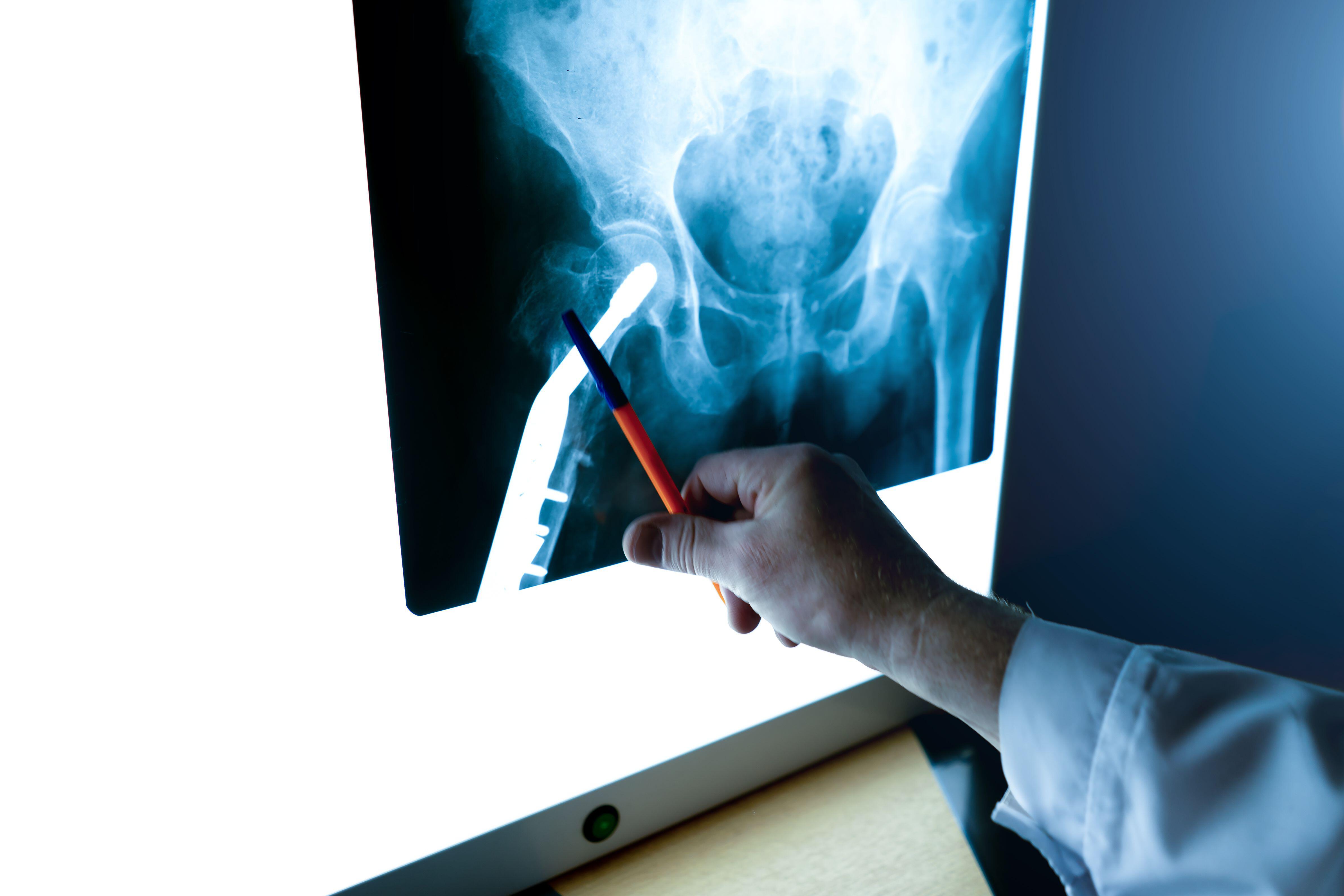 A radiologist examines an X-ray of the hip joint in close-up It is estimated that a third of females and 17% of males over 80 will suffer a hip fracture