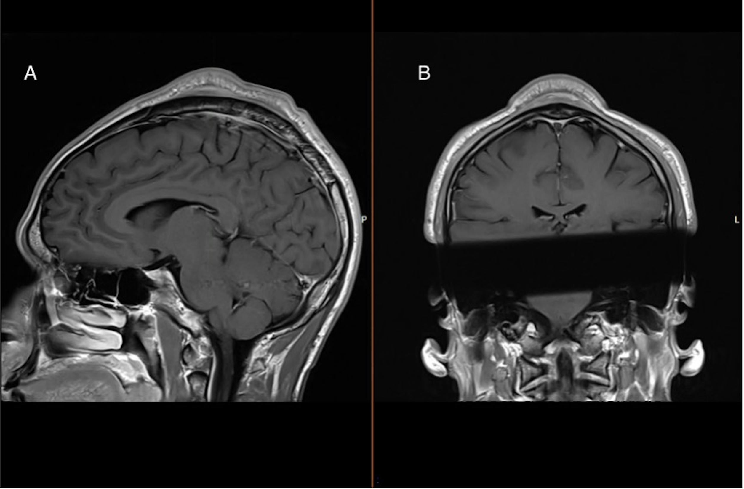 An MRI image of the breakdancer's head 