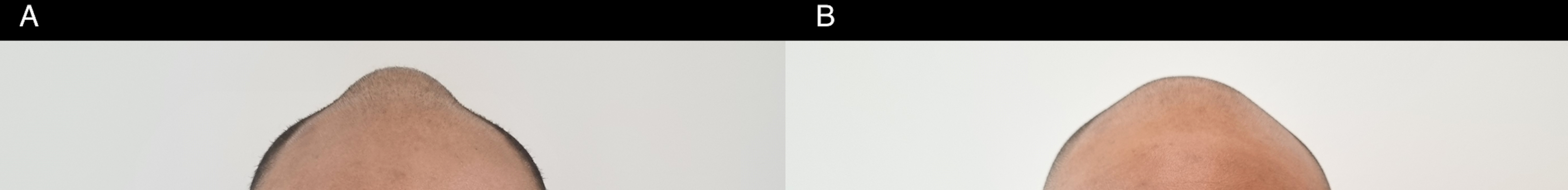 Pictures show the protuberance before and after the operation 