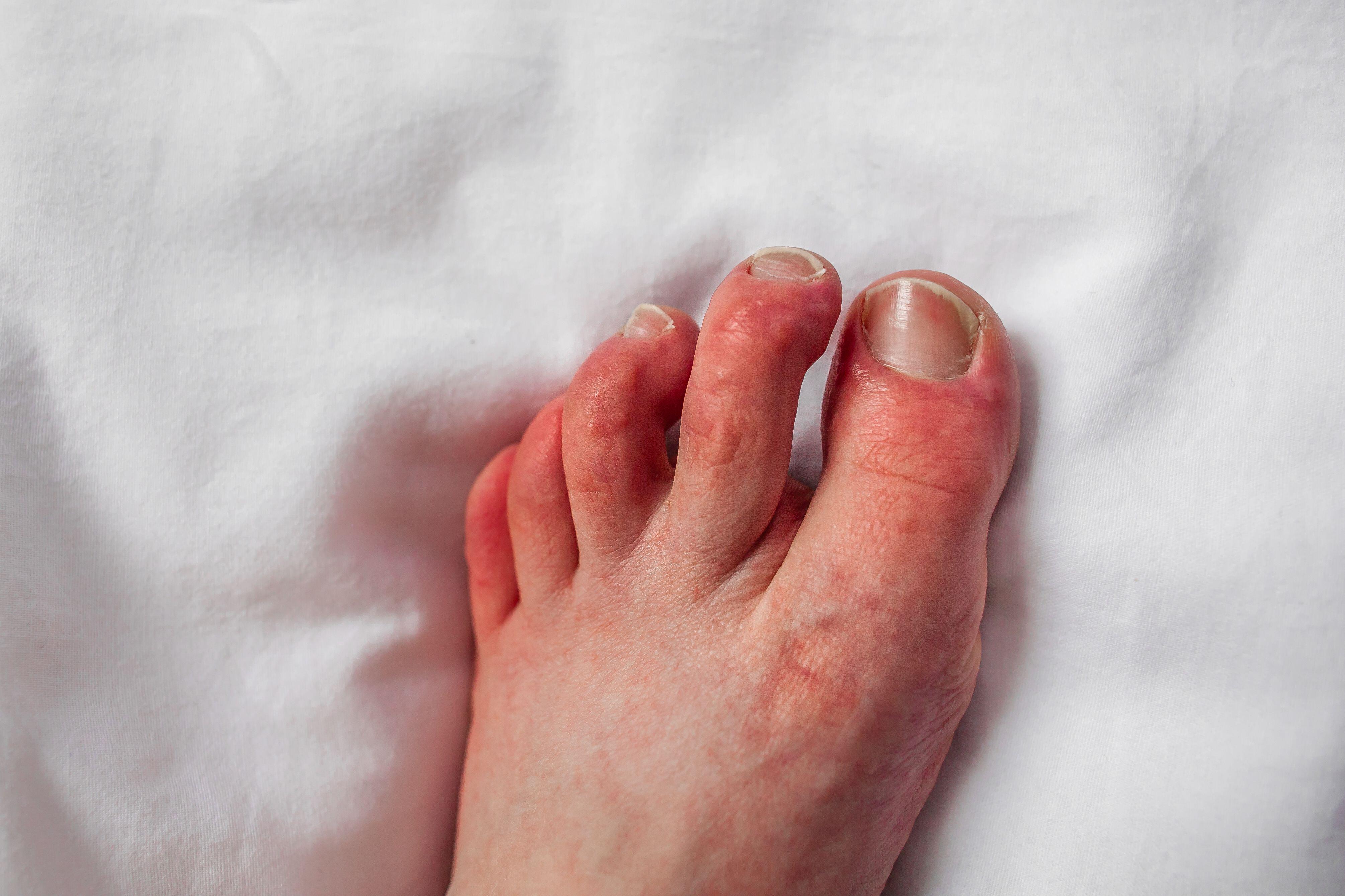 Lesions on feet (Alamy/PA)