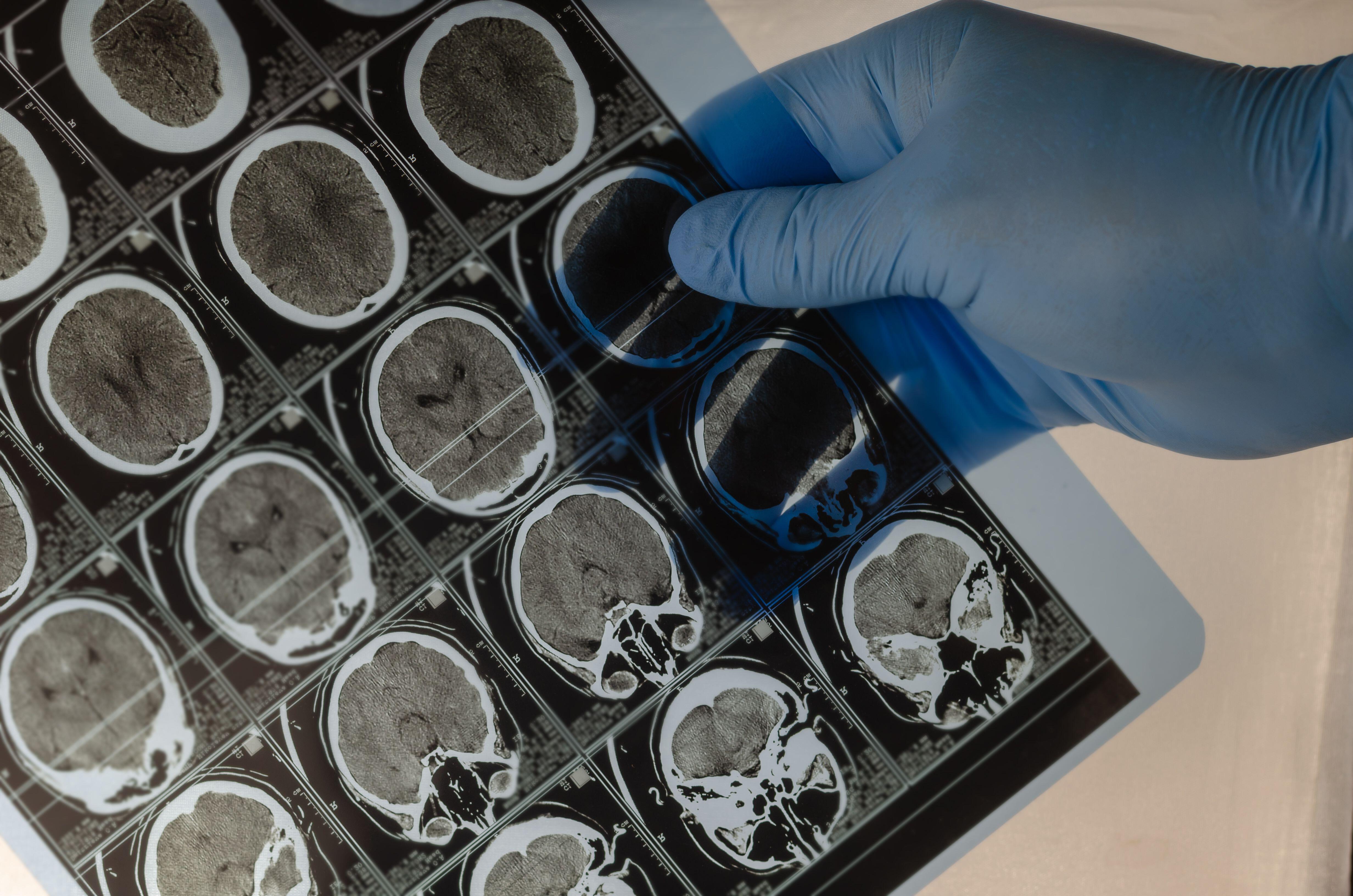 Neurosurgeon wearing blue medical glove holds Series of CAT Scans showing the human brain