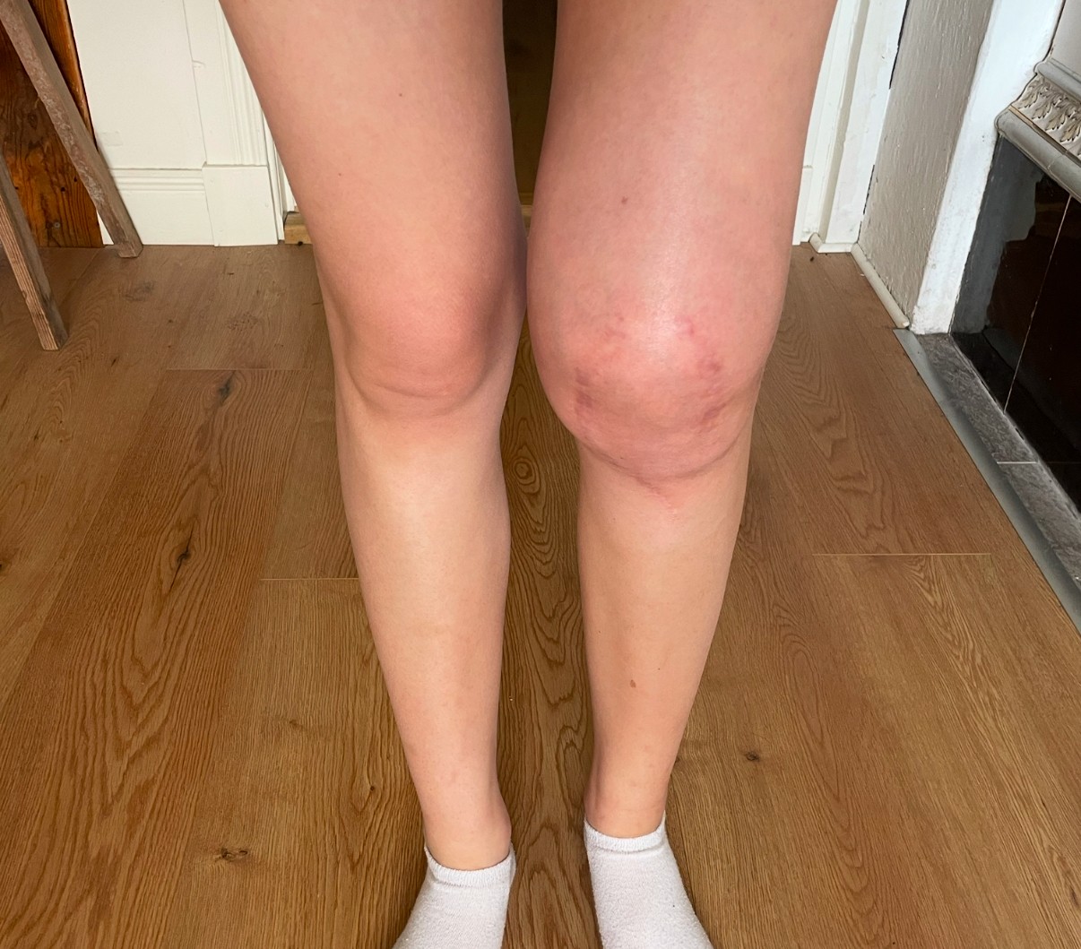 Alicia Ortstad's knee