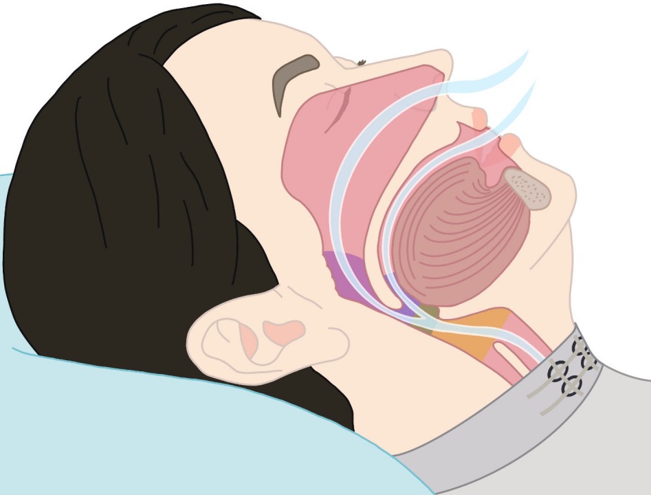 The monitoring of sleep behavior begins by detecting subtle vibrations at the extrinsic laryngeal muscle. (Cambridge University/ PA)