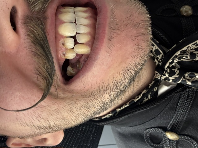 Lajos' teeth
