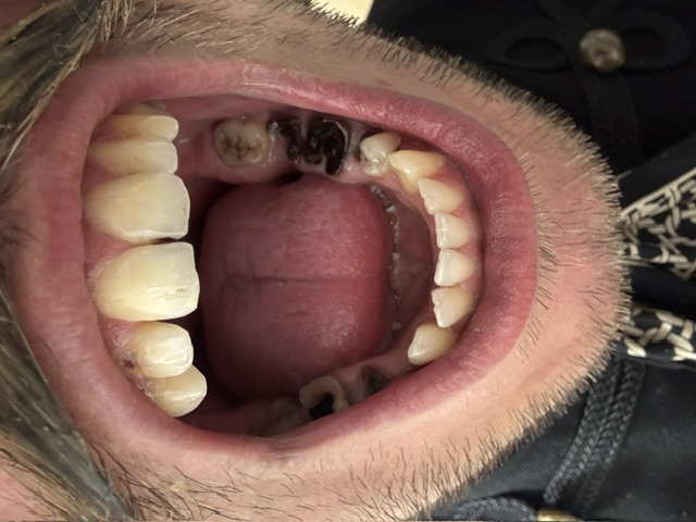 Lajos' teeth