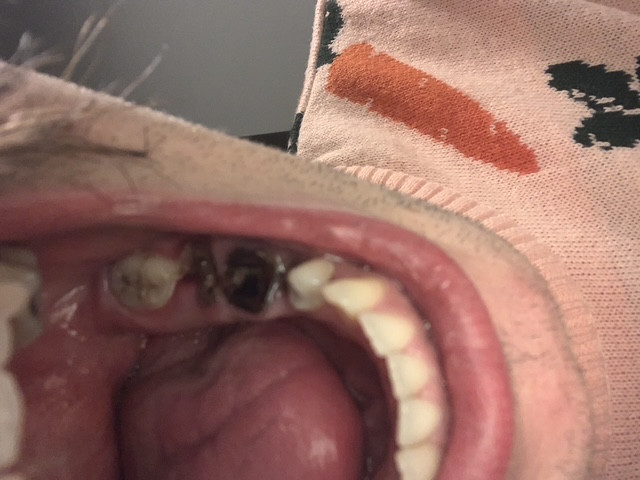 Lajos' teeth