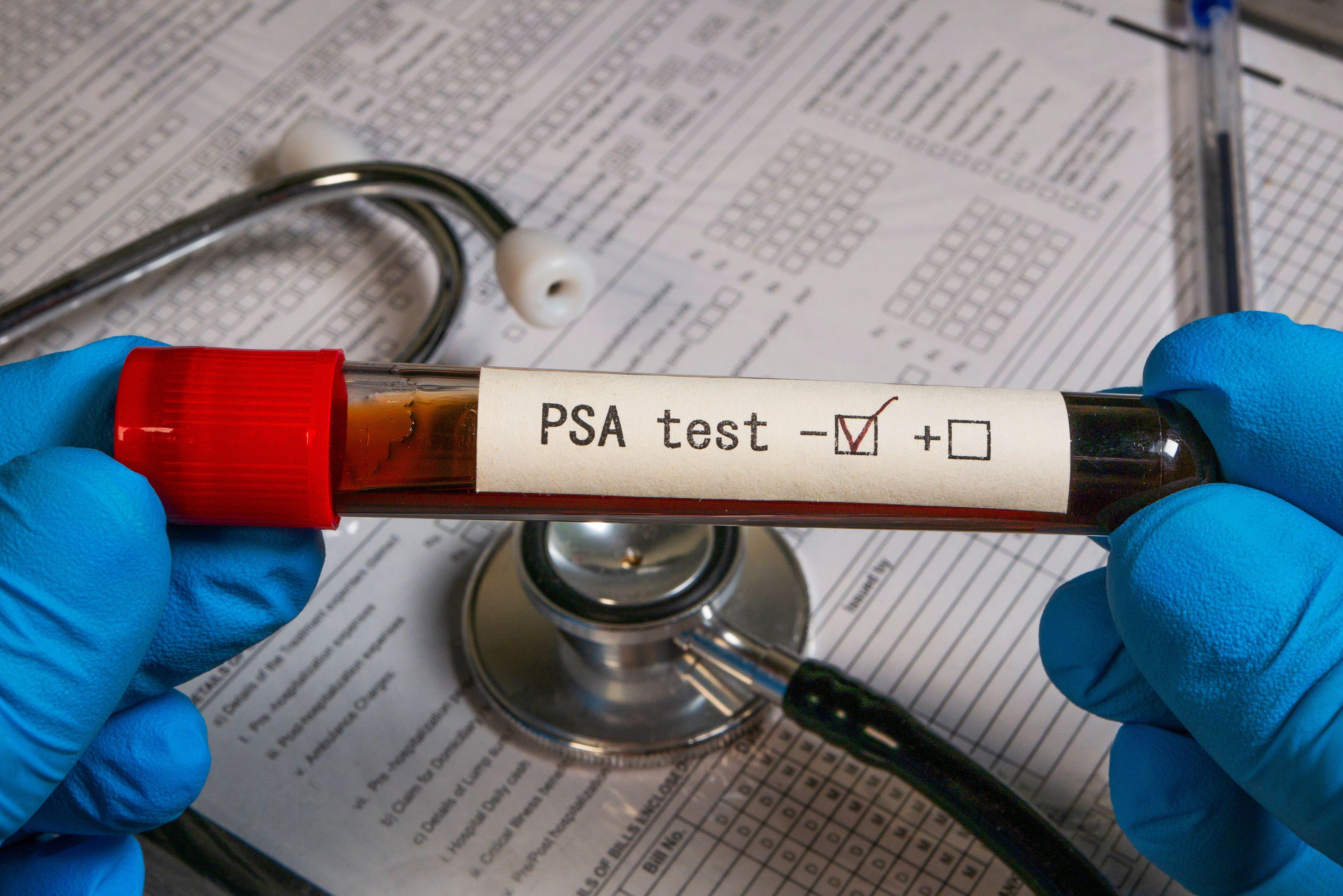 Doctor wearing blue gloves holding a test tube with negative PSA test result and a stethoscope on a medical form