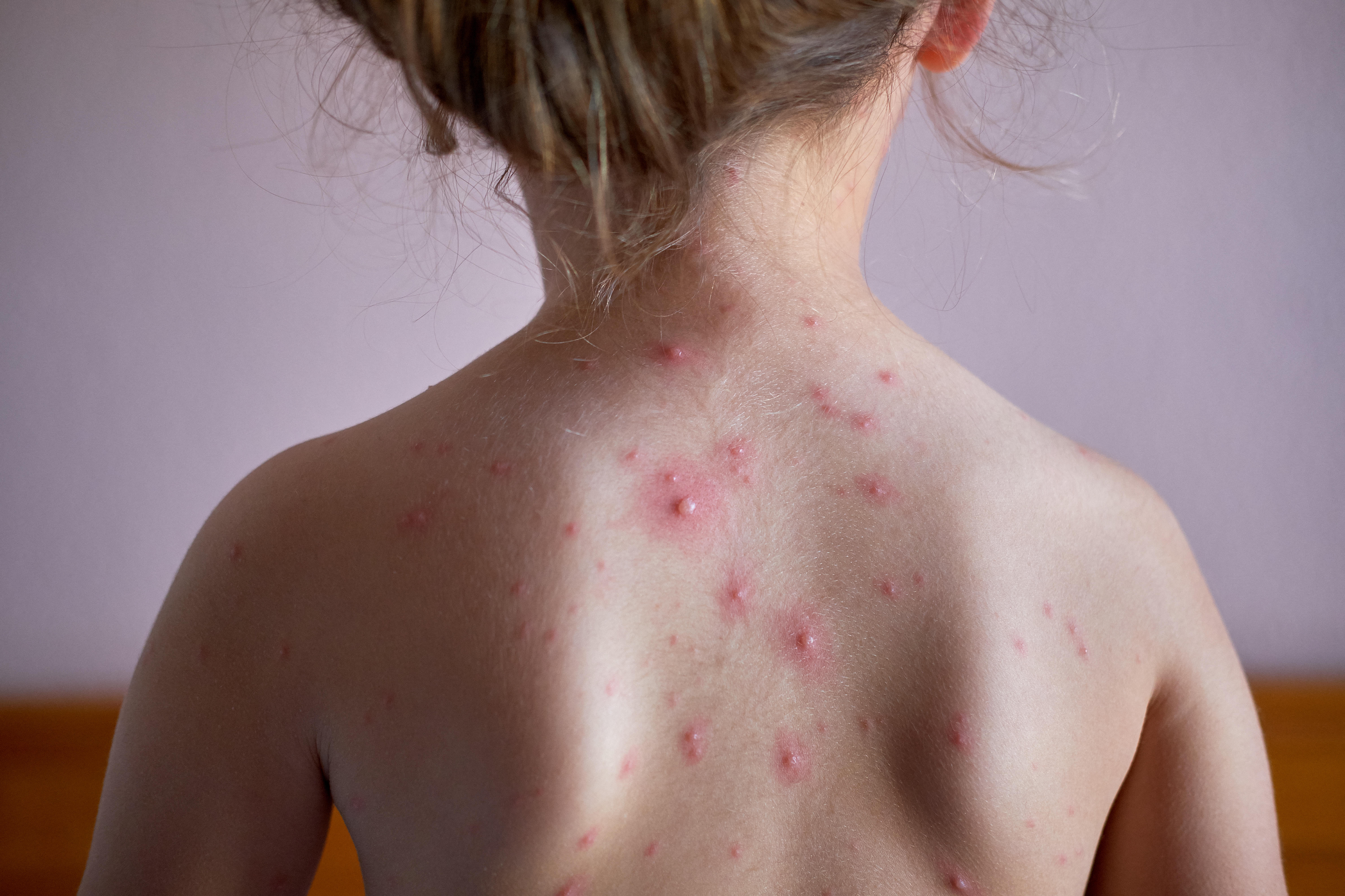 A child with chickenpox scars on their back