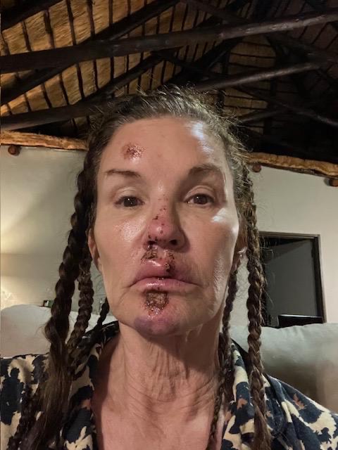 Janice Dickinson after sustaining injuries from a fall while on ITV's I'm A Celebrity... Get Me Out Of Here South Africa