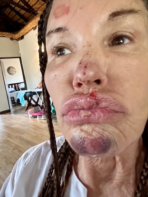 Janice Dickinson after sustaining injuries from a fall while on ITV's I'm A Celebrity...Get Me Out Of Here South Africa 