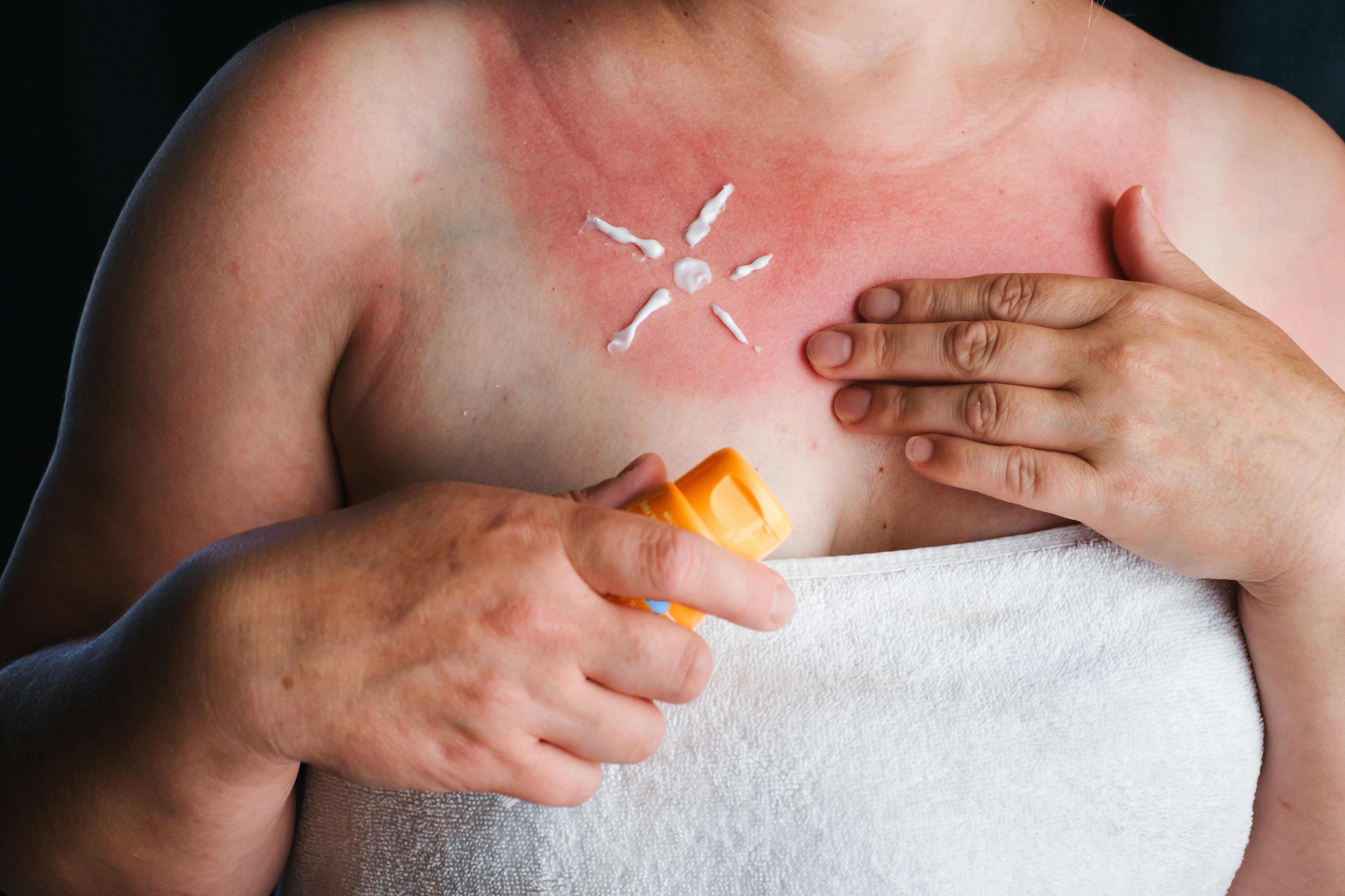 Woman applying soothing lotion on red sunburned skin on chest