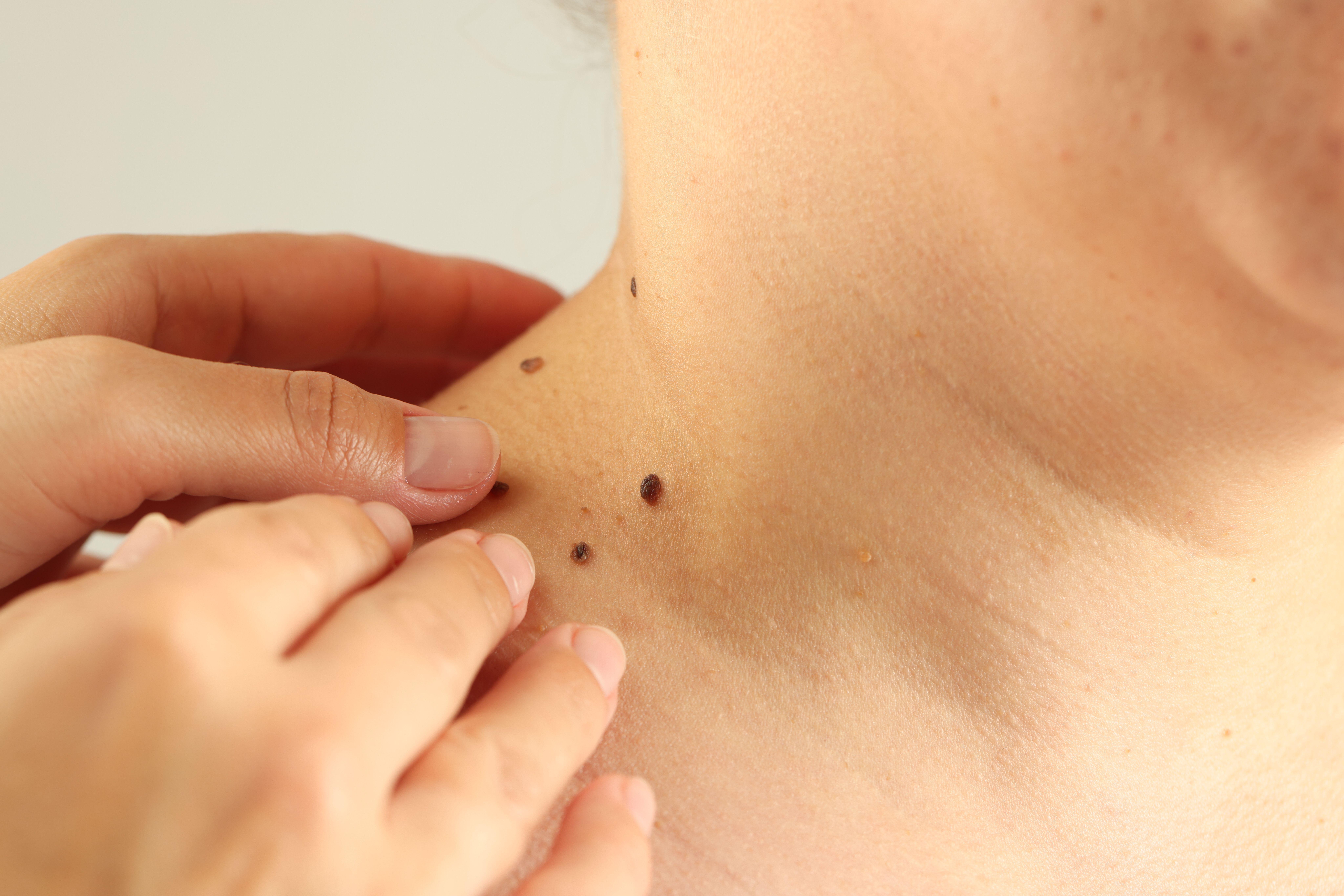 Doctor examining woman's moles on neck