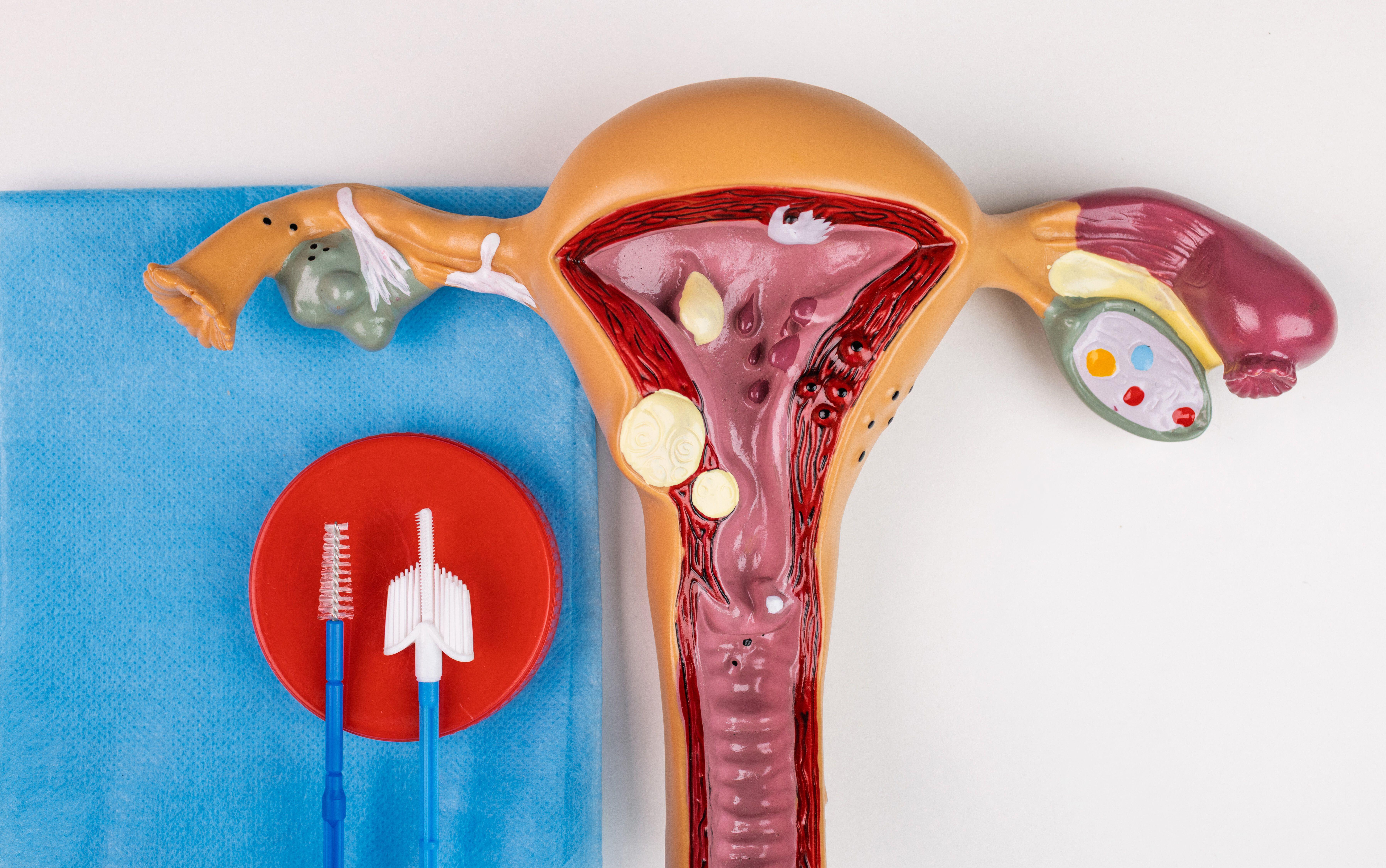Cervical brush and specimen container next to anatomical uterus model