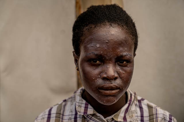 A young girl suffering from mpox waits for treatment at a clinic in Munigi 