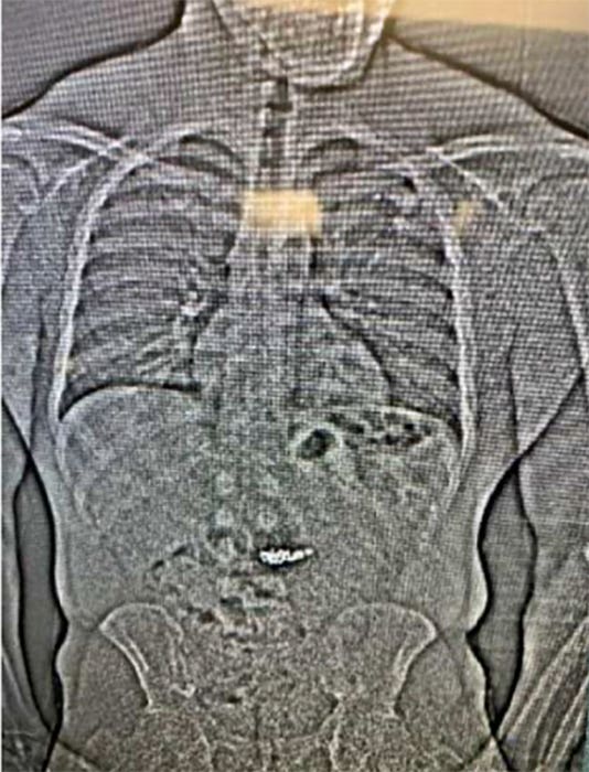 An image provided by police shows an X-ray of what are believed to be diamond earrings that were stolen from a Tiffany store in Florida and were swallowed by the suspect