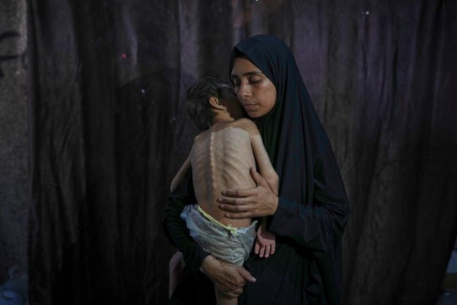 A Palestinian with her malnourished son in her arms